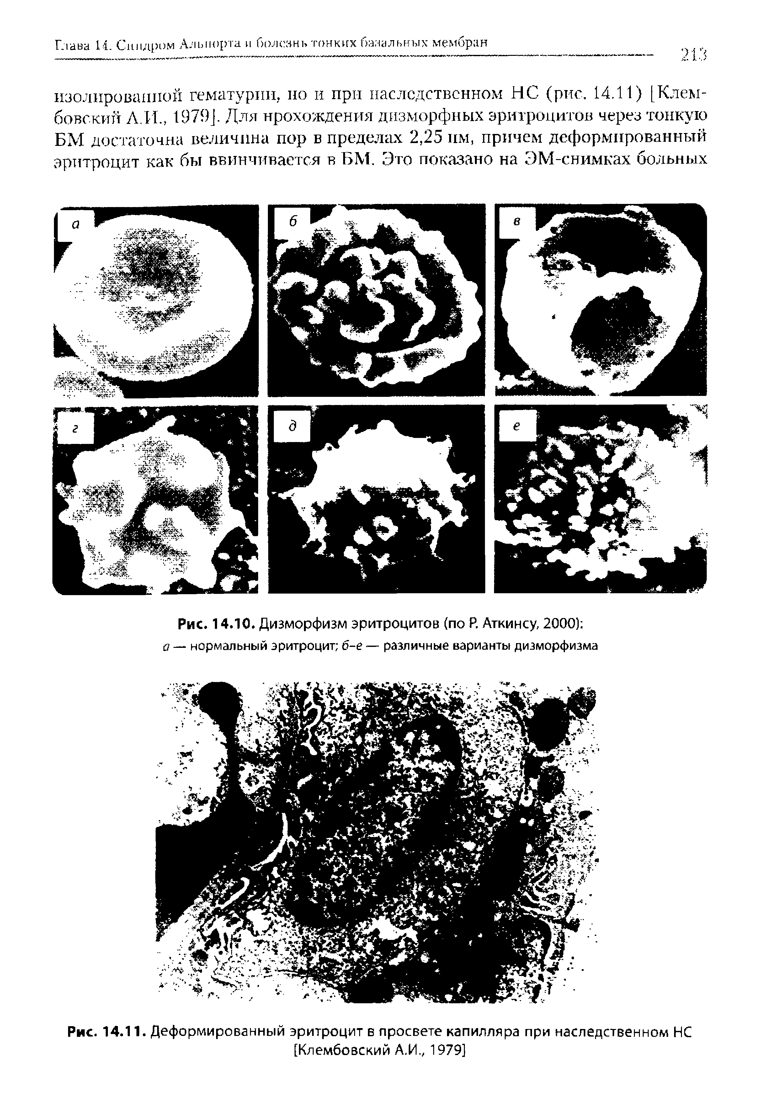 Рис. 14.10. Дизморфизм эритроцитов (по Р. Аткинсу, 2000) а — нормальный эритроцит б-е — различные варианты дизморфизма...