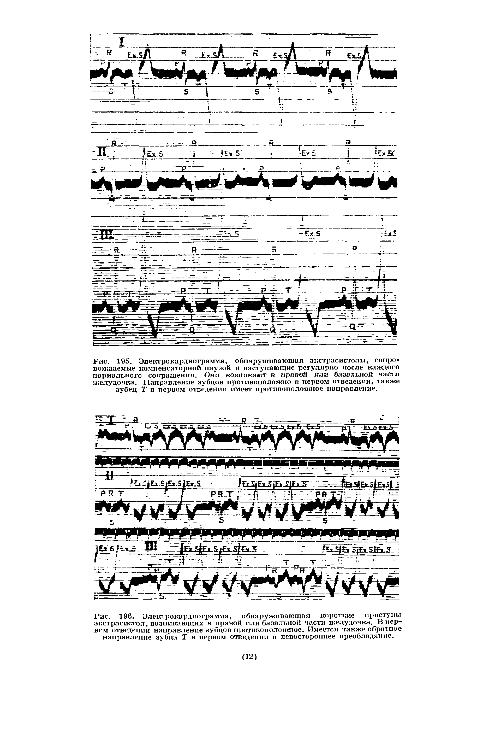 Рис. 195. Электрокардиограмма, обнаруживающая экстрасистолы, сопровождаемые компенсаторной паузой и наступающие регулярно после каждого нормального сокращения. Они возникают в правой или базальной части желудочка. Направление зубцов противоположно в первом отведении, также зубец Т в первом отведении имеет противоположное направление.