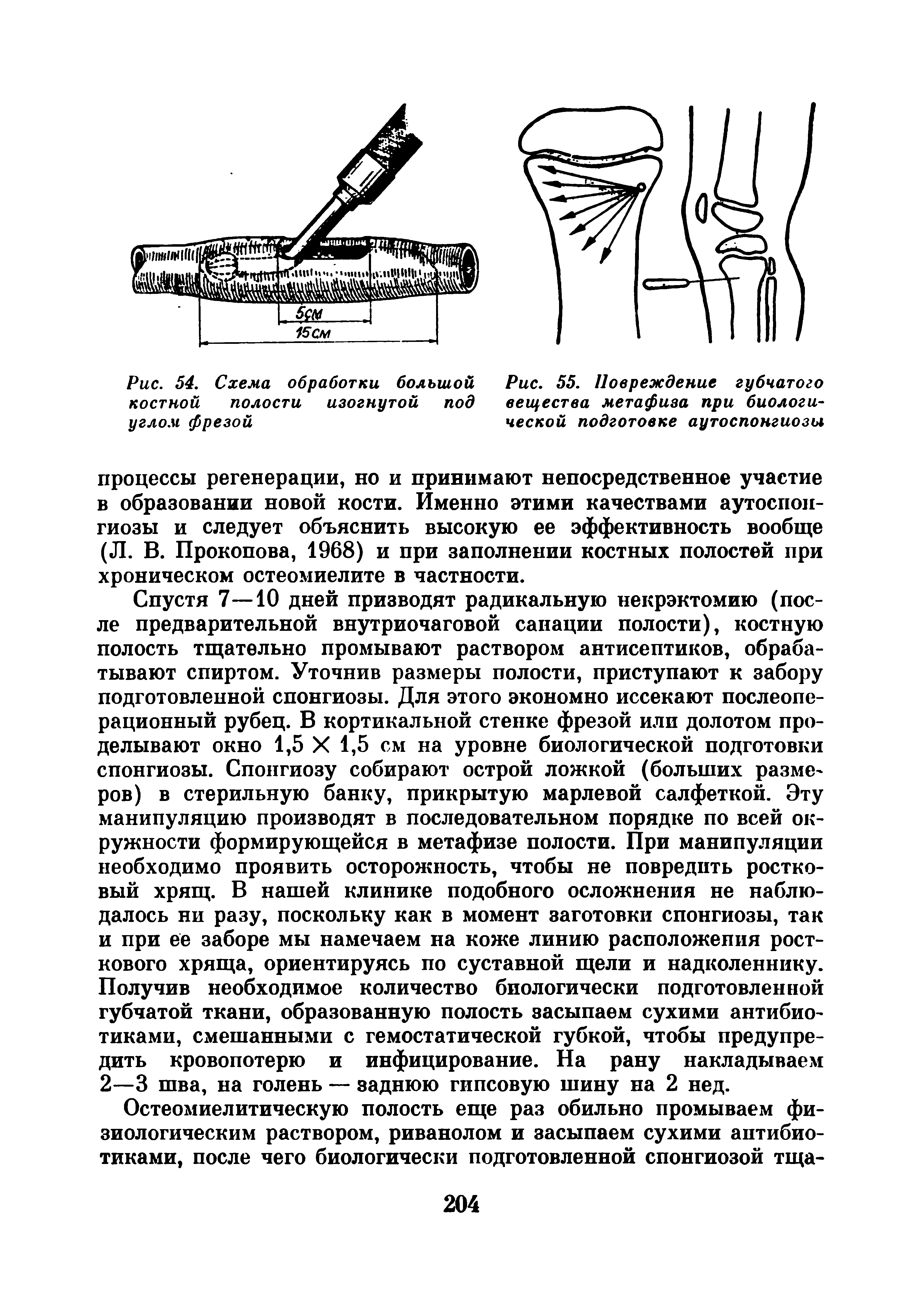 Рис. 55. Повреждение губчатого вещества метафиза при биологической подготовке аутоспонгиозы...