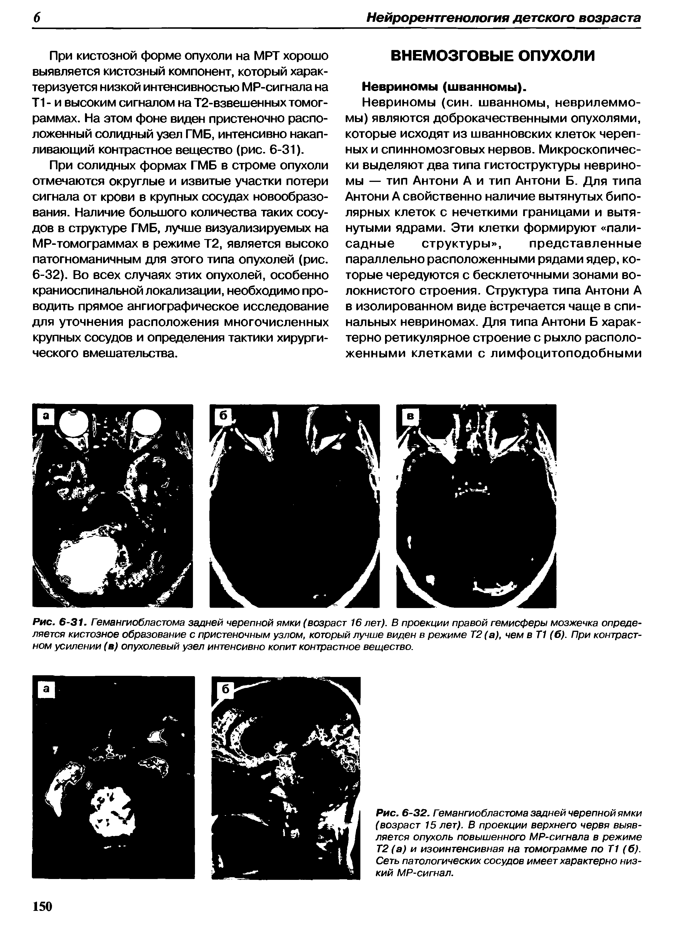 Рис. 6-32. Гемангиобластома задней черепной ямки (возраст 15 лет). В проекции верхнего червя выявляется опухоль повышенного МР-сигнала в режиме Т2 (а) и изоинтенсивная на томограмме по Т1 (б). Сеть патологических сосудов имеет характерно низкий МР-сигнал.