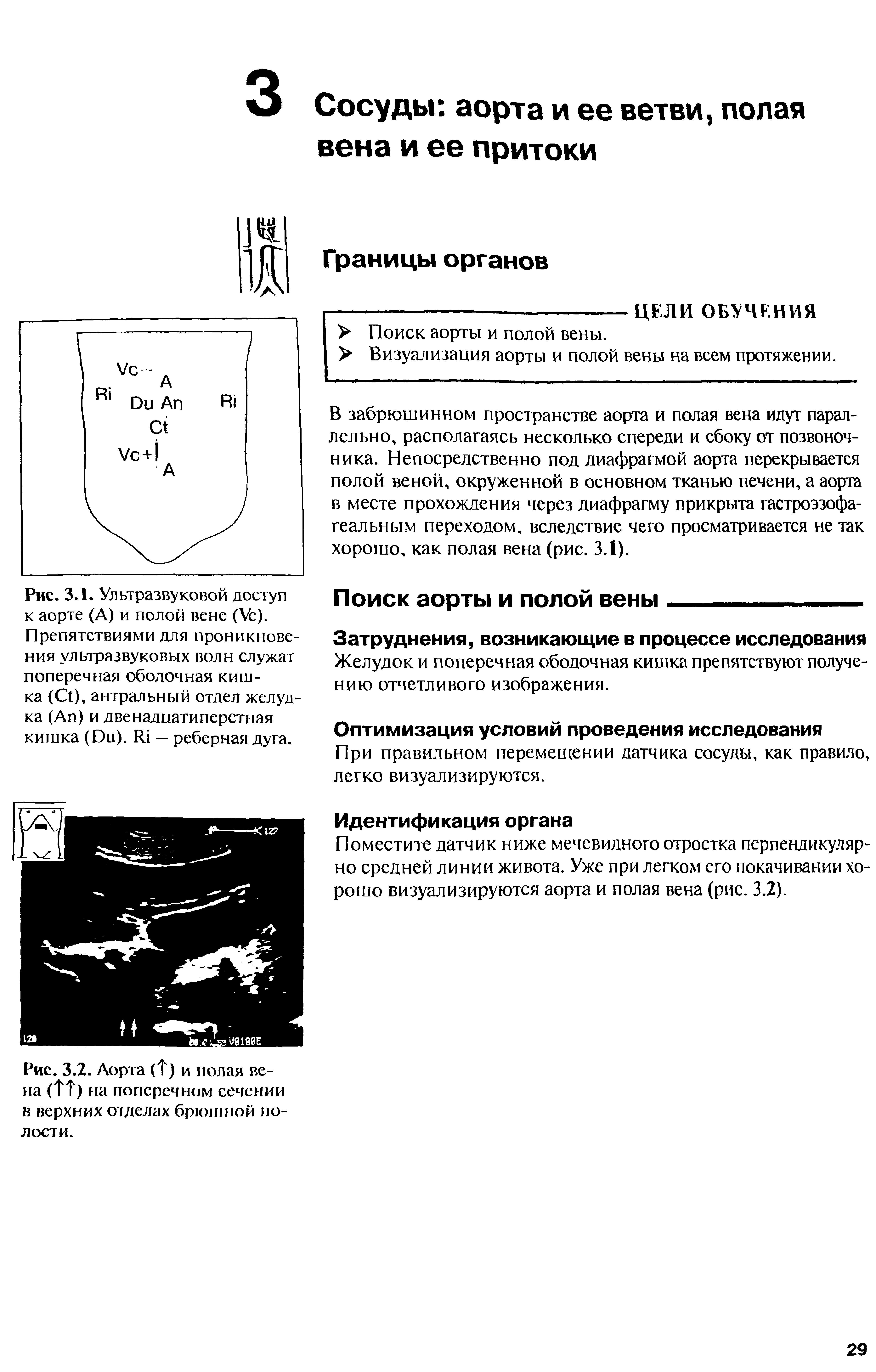 Рис. 3.2. Аорта (1) и полая вена (ТТ) на поперечном сечении в верхних отделах брюшной полости.