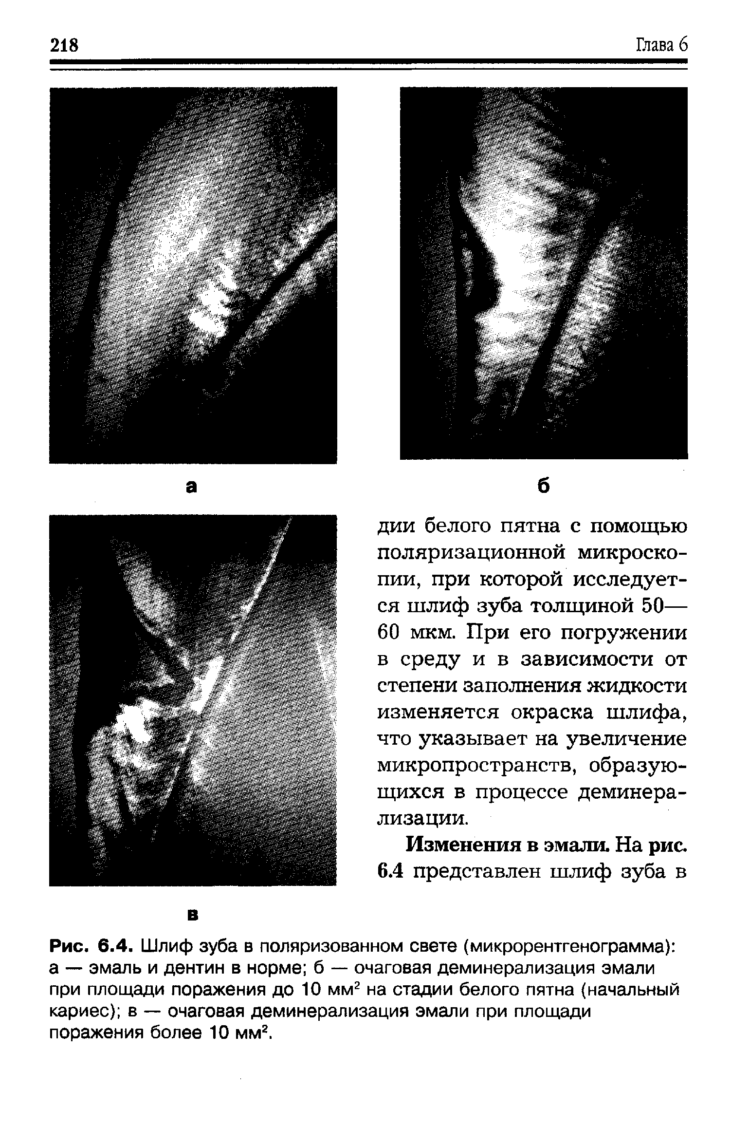 Рис. 6.4. Шлиф зуба в поляризованном свете (микрорентгенограмма) а — эмаль и дентин в норме б — очаговая деминерализация эмали при площади поражения до 10 мм2 на стадии белого пятна (начальный кариес) в — очаговая деминерализация эмали при площади поражения более 10 мм2.