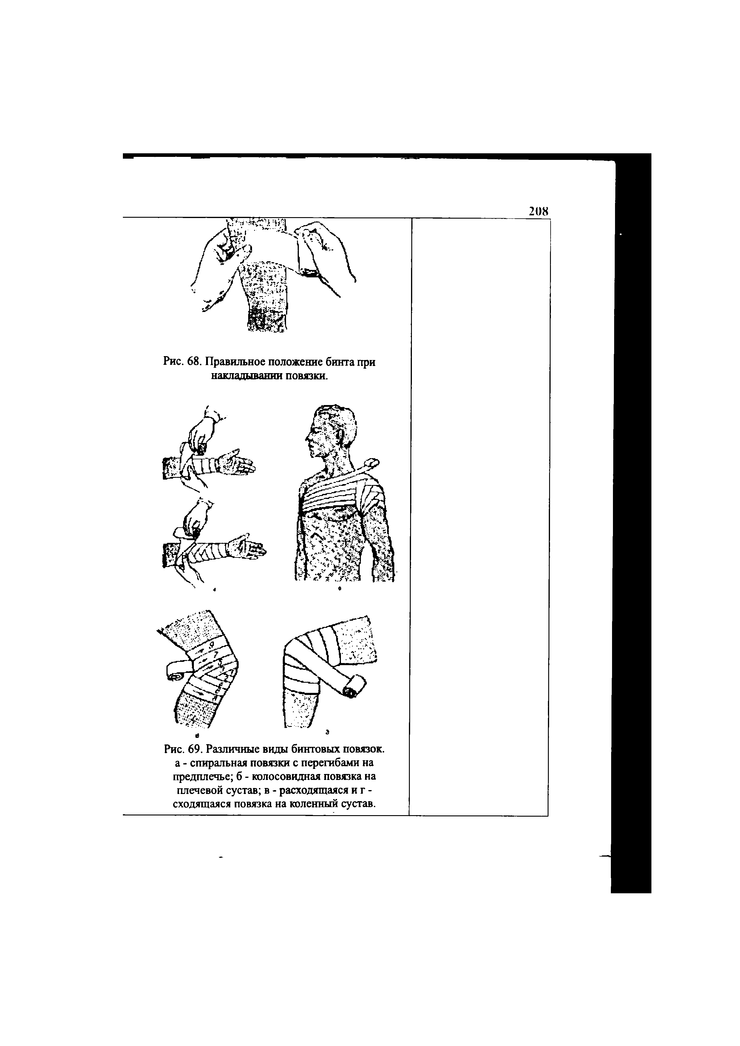 Рис. 69. Различные виды бинтовых повязок, а - спиральная повязки с перегибами на предплечье б - колосовидная повязка на плечевой сустав в - расходящаяся иг -сходящаяся повязка на коленный сустав.