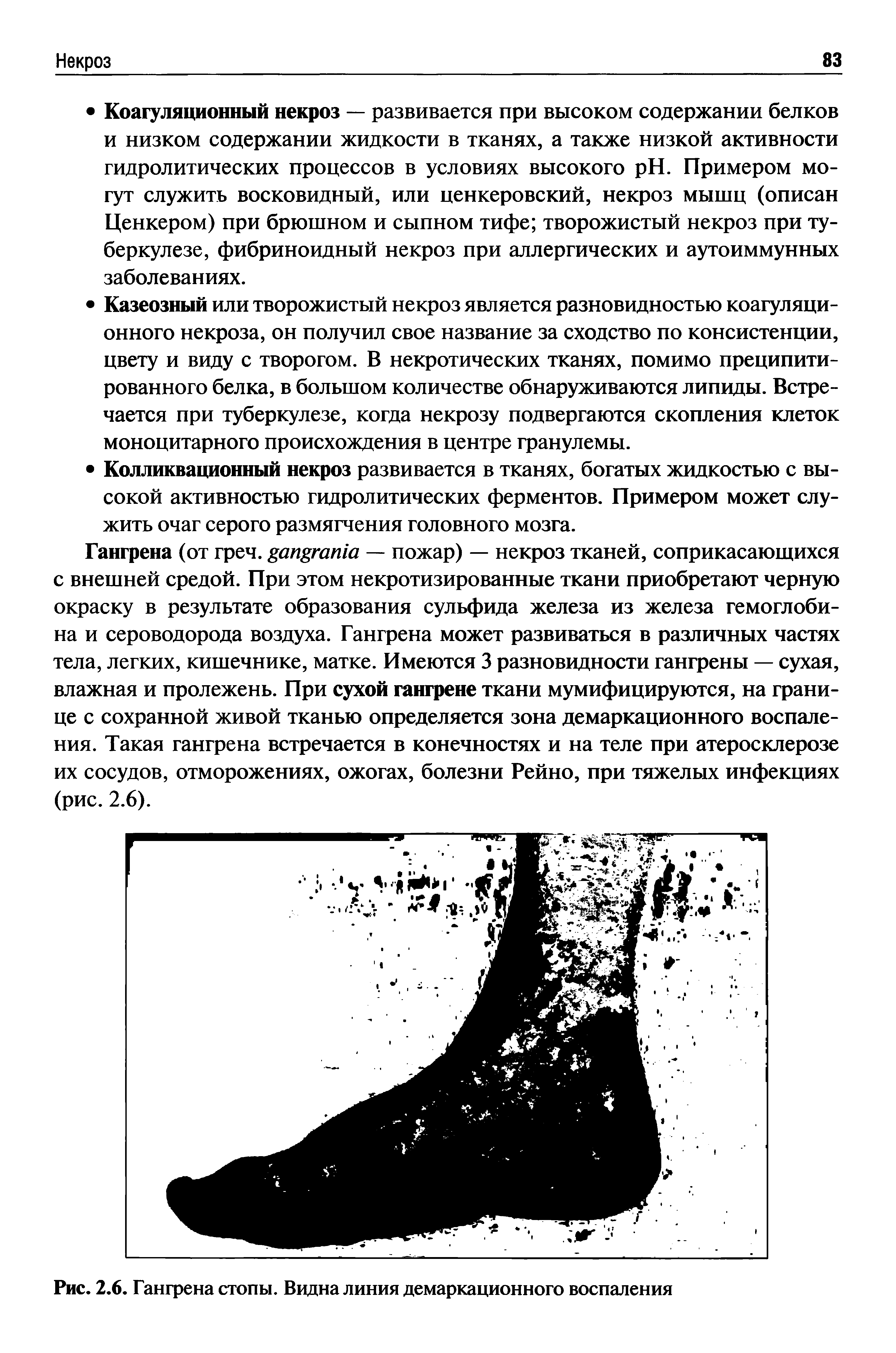 Рис. 2.6. Гангрена стопы. Видна линия демаркационного воспаления...