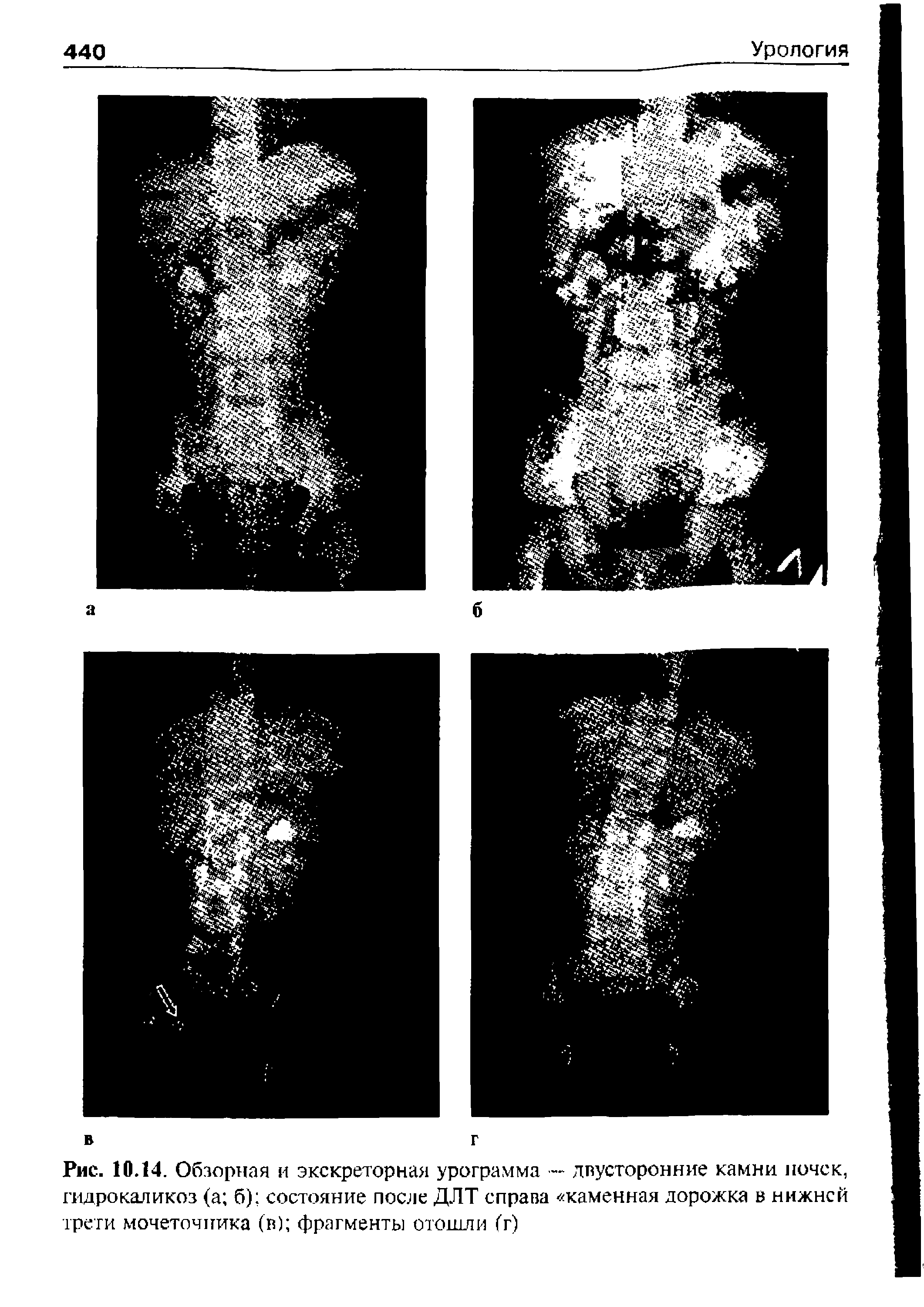 Рис. 10.14. Обзорная и экскреторная урограмма — двусторонние камни ночек, гидрокаликоз (а б) состояние после ДЛТ справа каменная дорожка в нижней трети мочеточника (в) фрагменты отошли (г)...