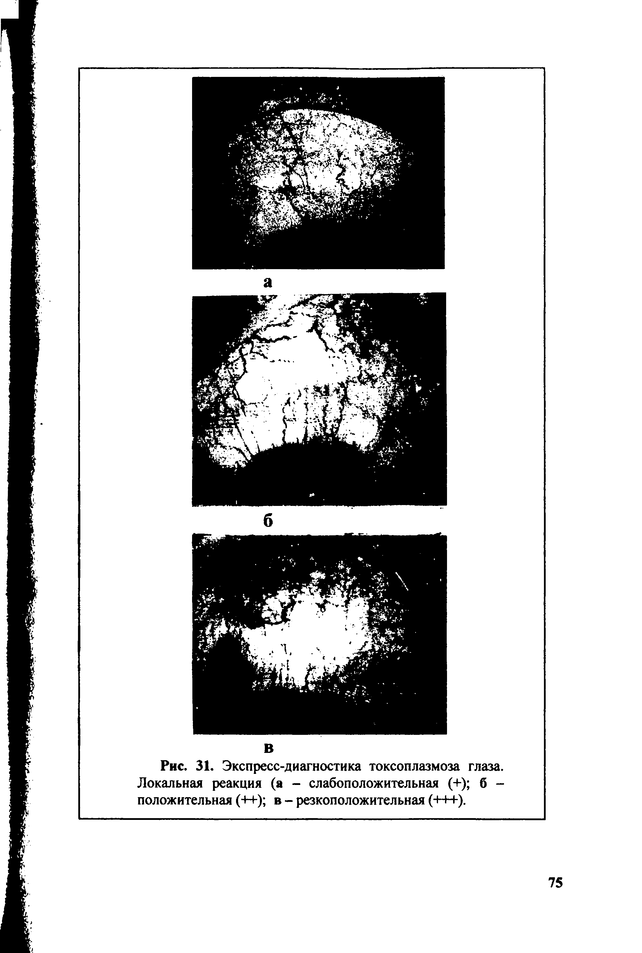 Рис. 31. Экспресс-диагностика токсоплазмоза глаза. Локальная реакция (а - слабоположительная (+) б -положительная (++) в - резкоположительная (+++).