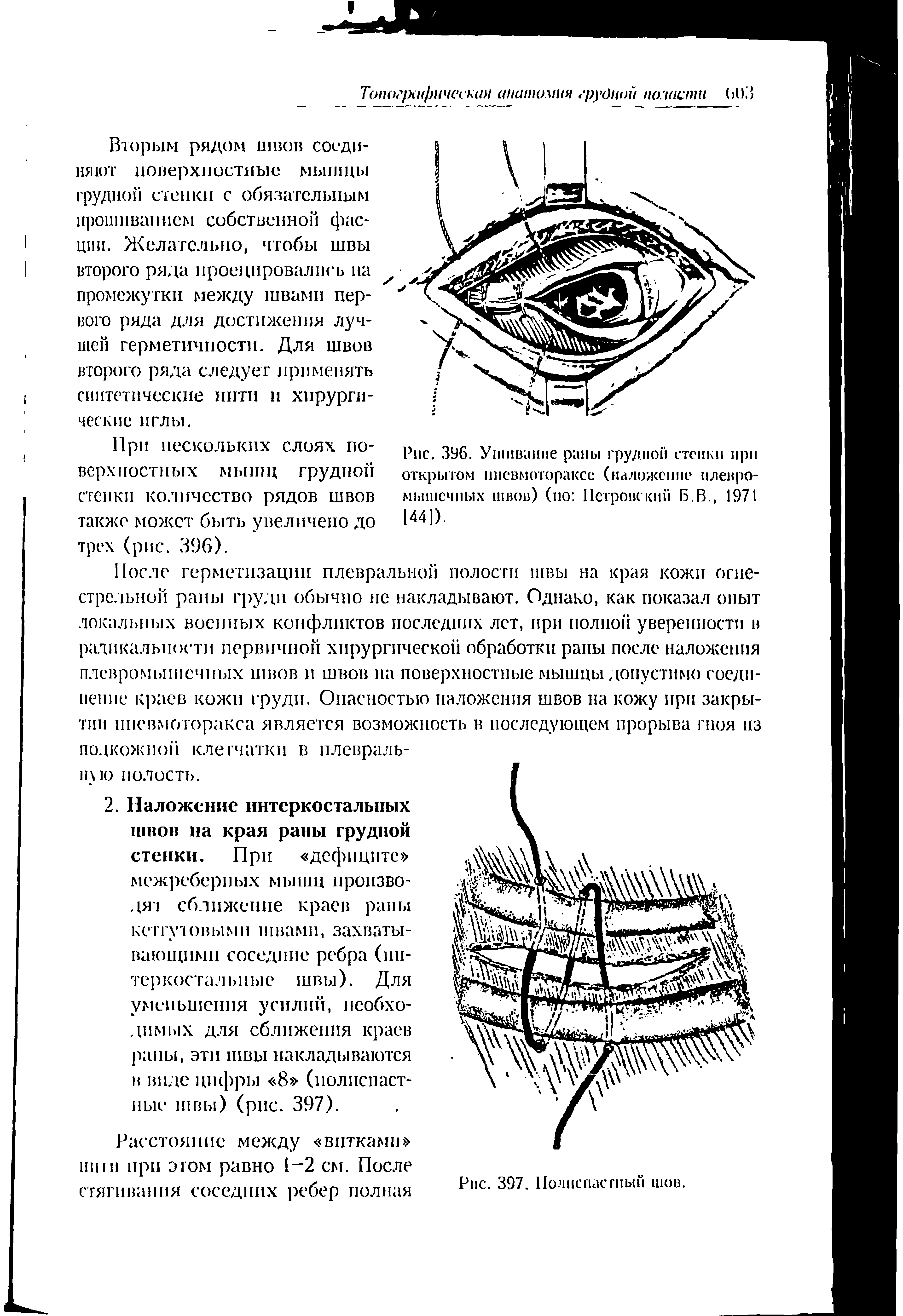 Рис. 396. Ушивание раны грудной стенки при открытом пневмотораксе (наложение плевромышечных швов) (по Петровский Б.В., 1971 144]).