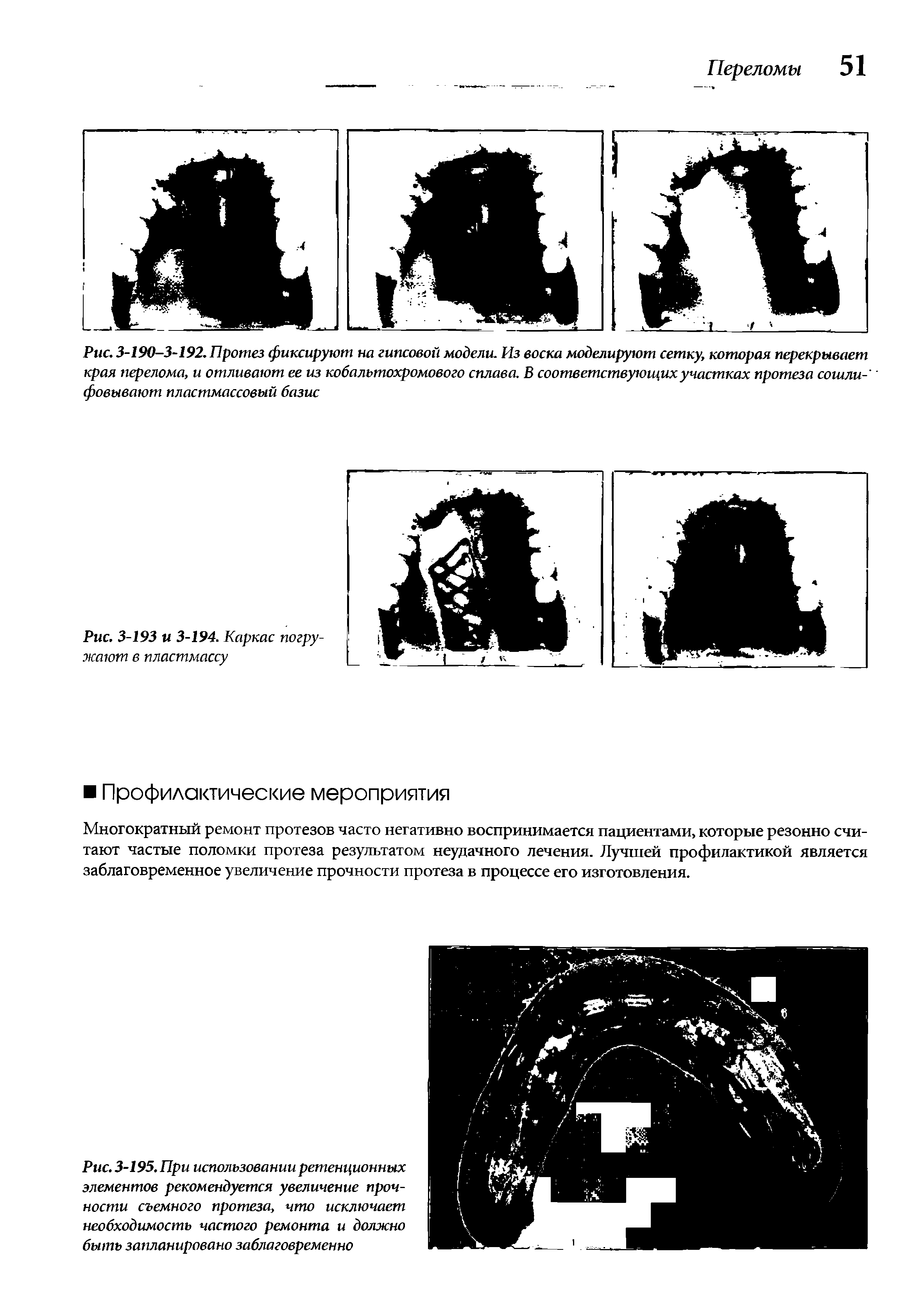 Рис. 3-195. При использовании ретенционных элементов рекомендуется увеличение прочности съемного протеза, что исключает необходимость частого ремонта и должно быть запланировано заблаговременно...