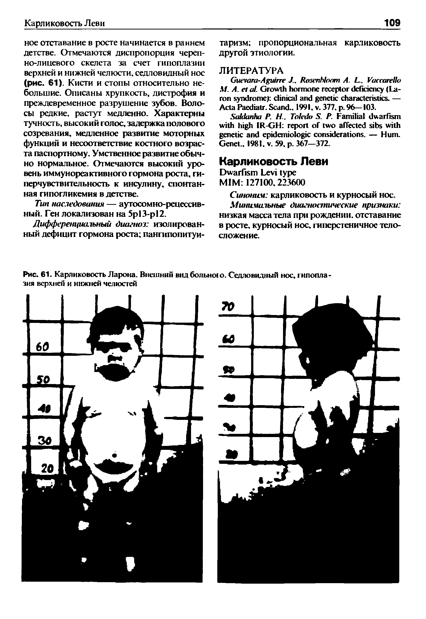 Рис. 61. Карликовость Ларона. Внешний вид больно о. Седловидный нос, гипоплазия верхней и нижней челюстей...