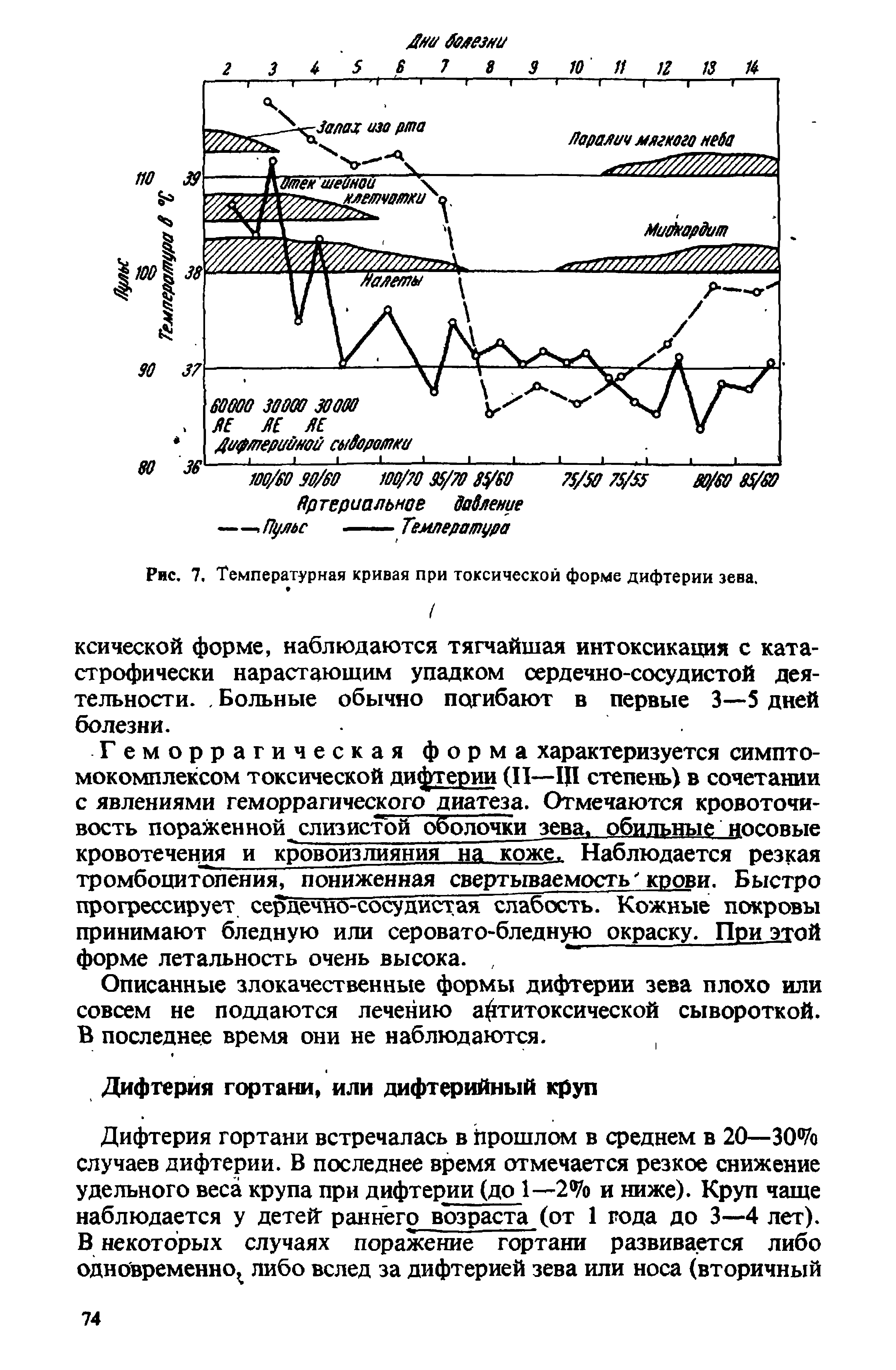 Рис. 7, Температурная кривая при токсической форме дифтерии зева.