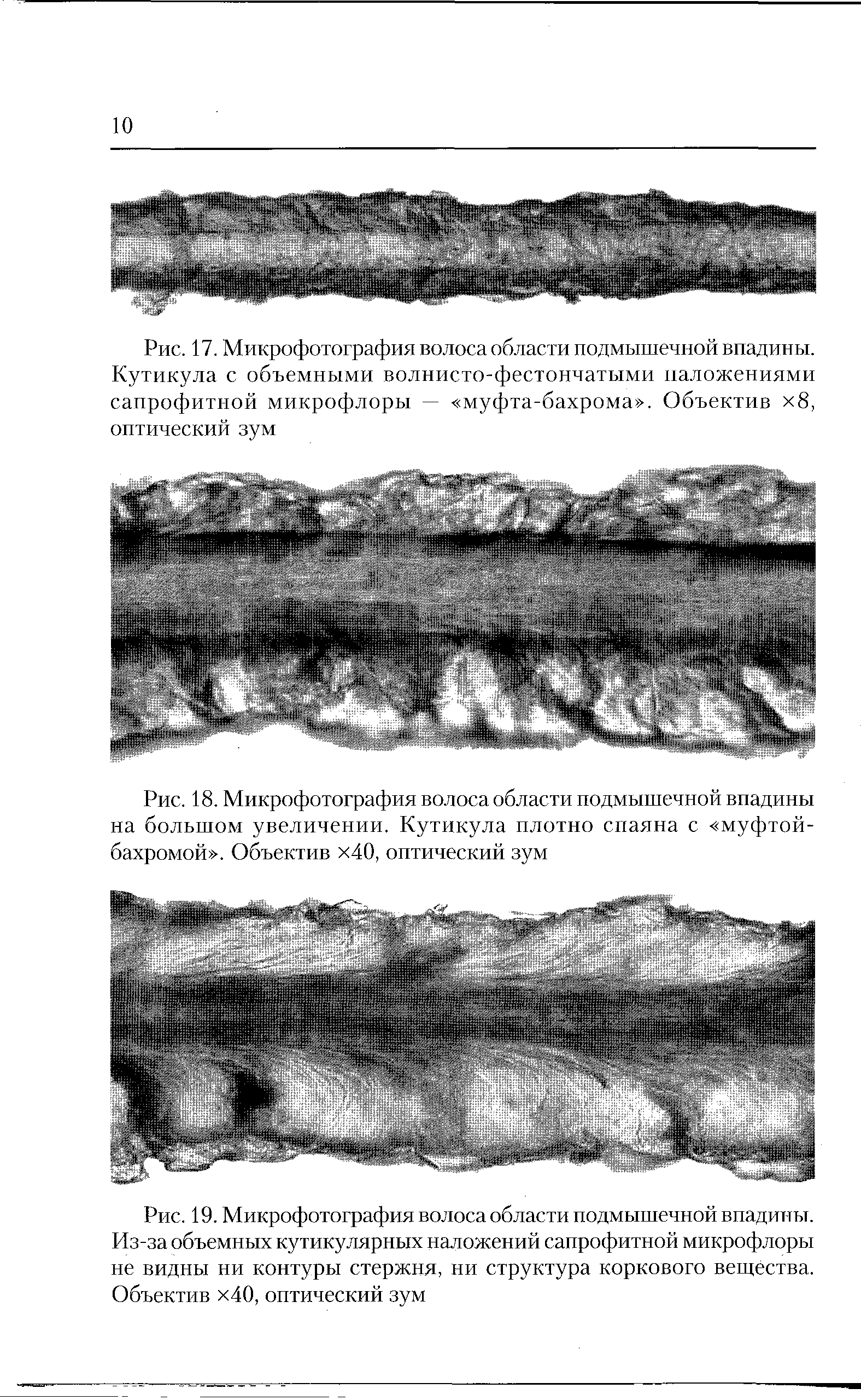 Рис. 19. Микрофотография волоса области подмышечной впадиньт. Из-за объемных кутикулярных наложений сапрофитной микрофлоры не видны ни контуры стержня, ни структура коркового вещества. Объектив х40, оптический зум...