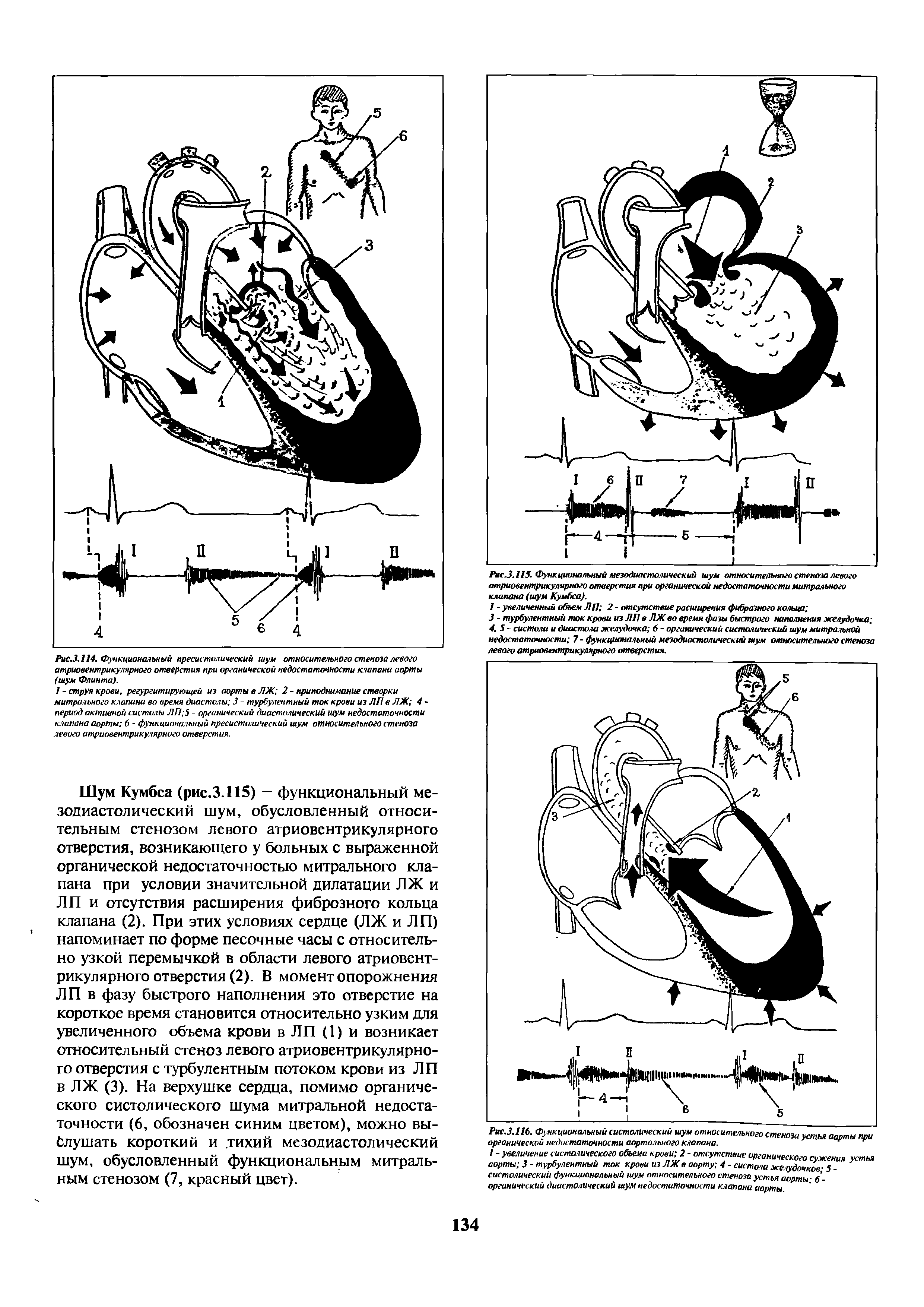 Рис.3.115. Функциональный мезодиастолический шум относительного стеноза левого атриовентрикулярного отверстия при органической недостаточнос ти митрального клапана (шум Кумбса).