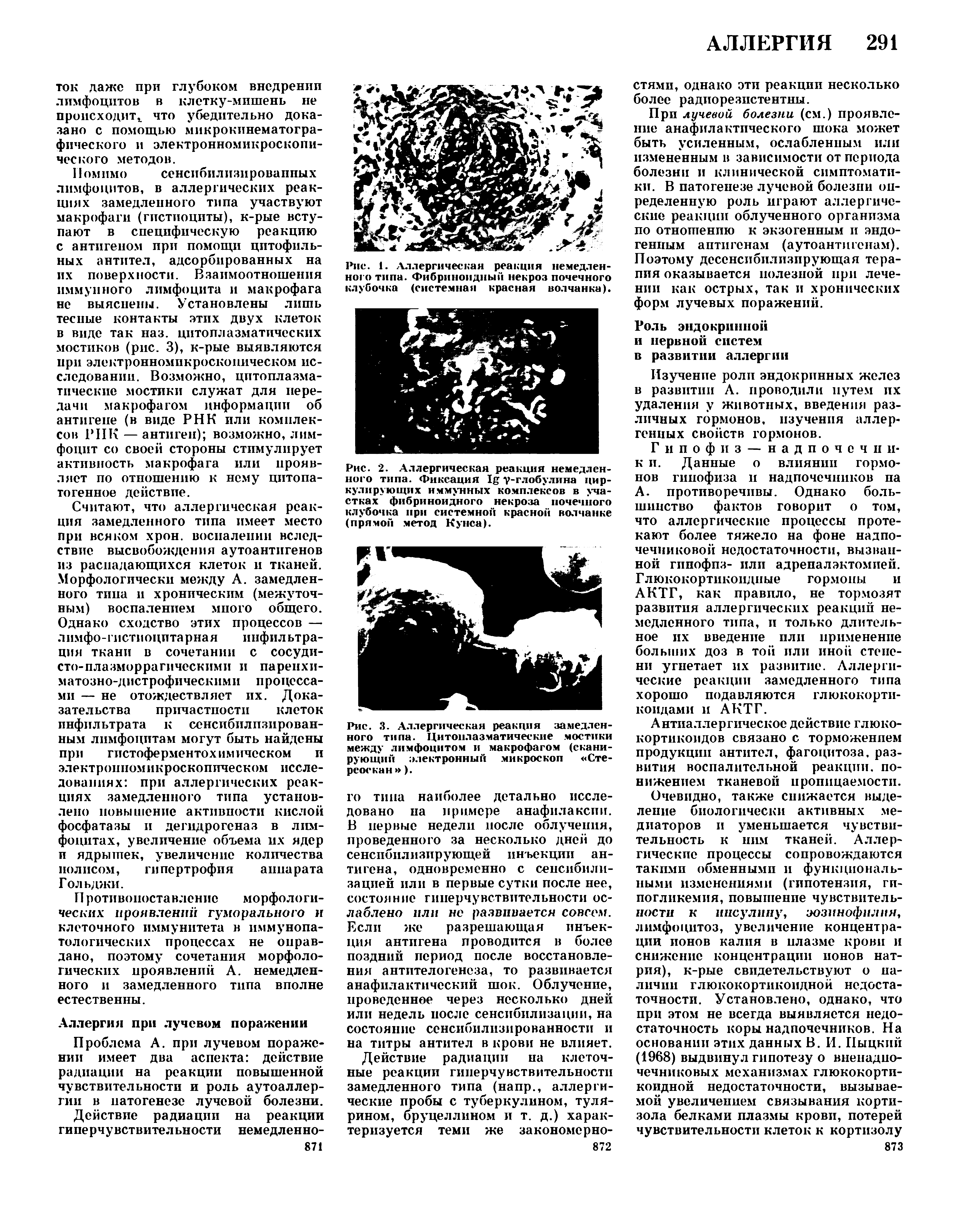 Рис. 2. Аллергическая реакция немедленного типа. Фиксация у-глобулина циркулирующих иммунных комплексов в участках фибриноидного некроза почечного клубочка при системной красной волчанке (прямой метод Кунса).