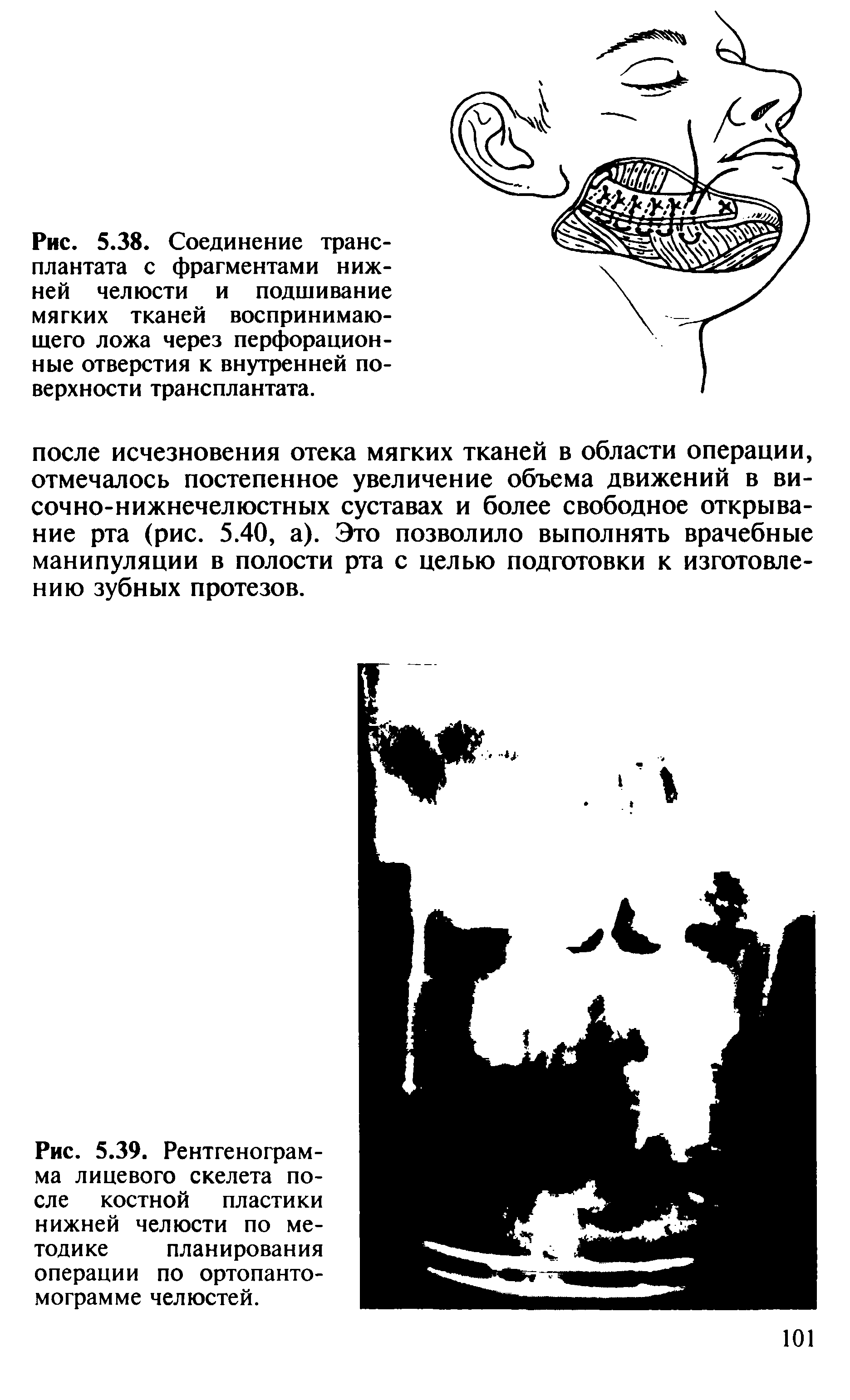 Рис. 5.39. Рентгенограмма лицевого скелета после костной пластики нижней челюсти по методике планирования операции по ортопантомограмме челюстей.