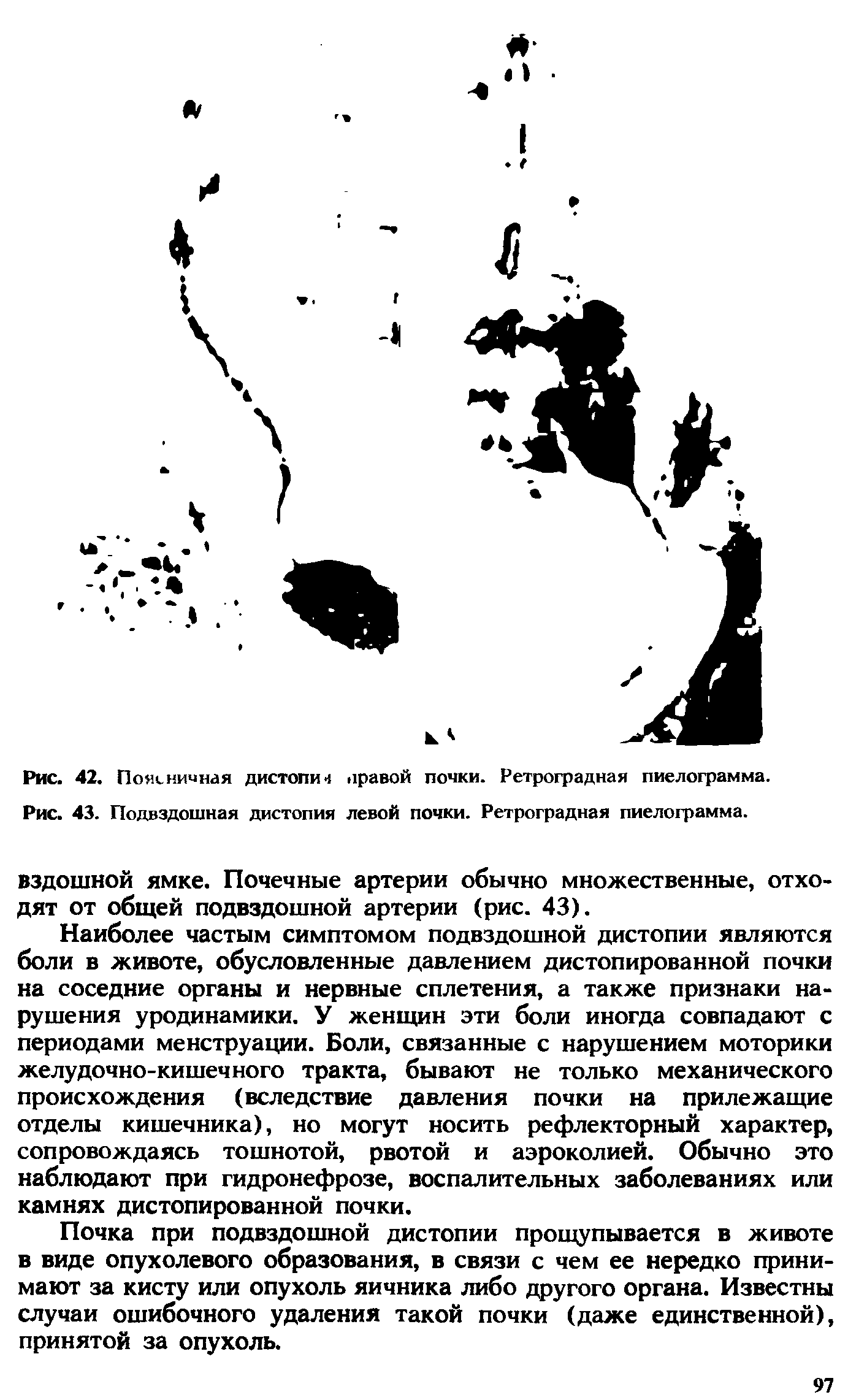 Рис. 43. Подвздошная дистопия левой почки. Ретроградная пиелограмма.