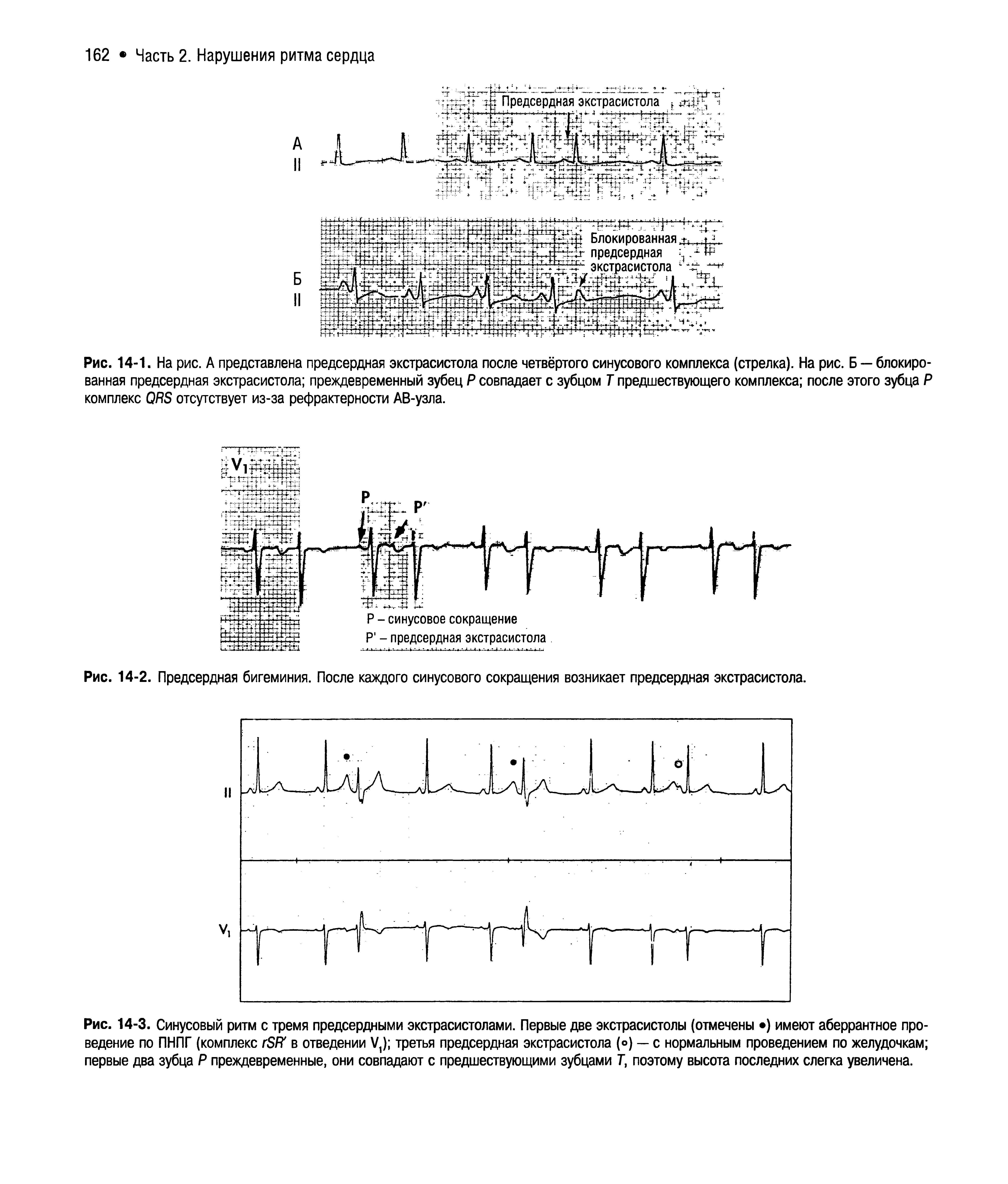 Рис. 14-1. На рис. А представлена предсердная экстрасистола после четвёртого синусового комплекса (стрелка). На рис. Б — блокированная предсердная экстрасистола преждевременный зубец Р совпадает с зубцом Т предшествующего комплекса после этого зубца Р комплекс ОЯЯ отсутствует из-за рефрактерности АВ-узла.