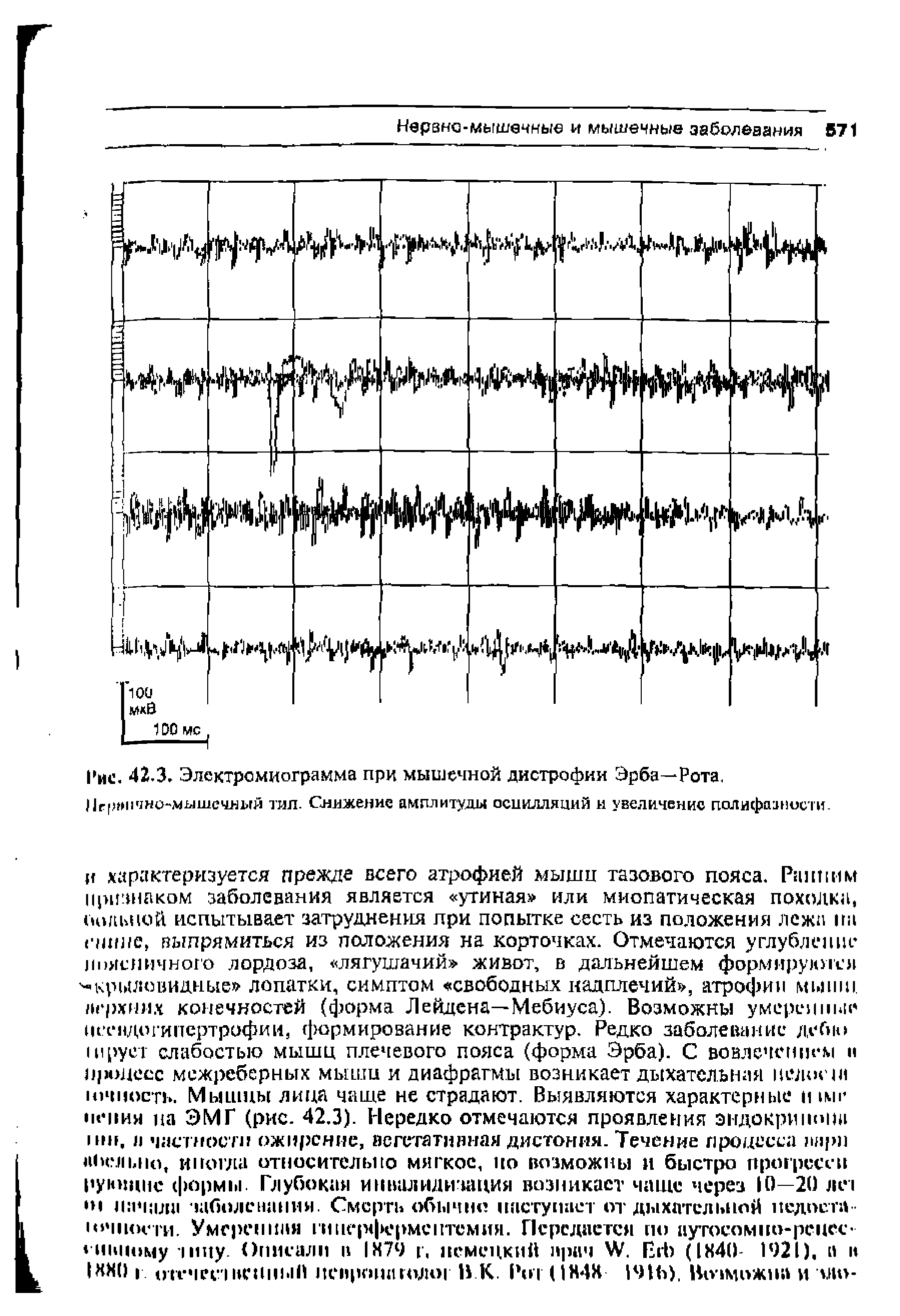 Рис. 42.3. Электромиограмма при мышечной дистрофии Эрба—Рота. )1г()1 ично мышечн1>гй тал. Снижение амплитуды осцилляций и увеличение полифааности.