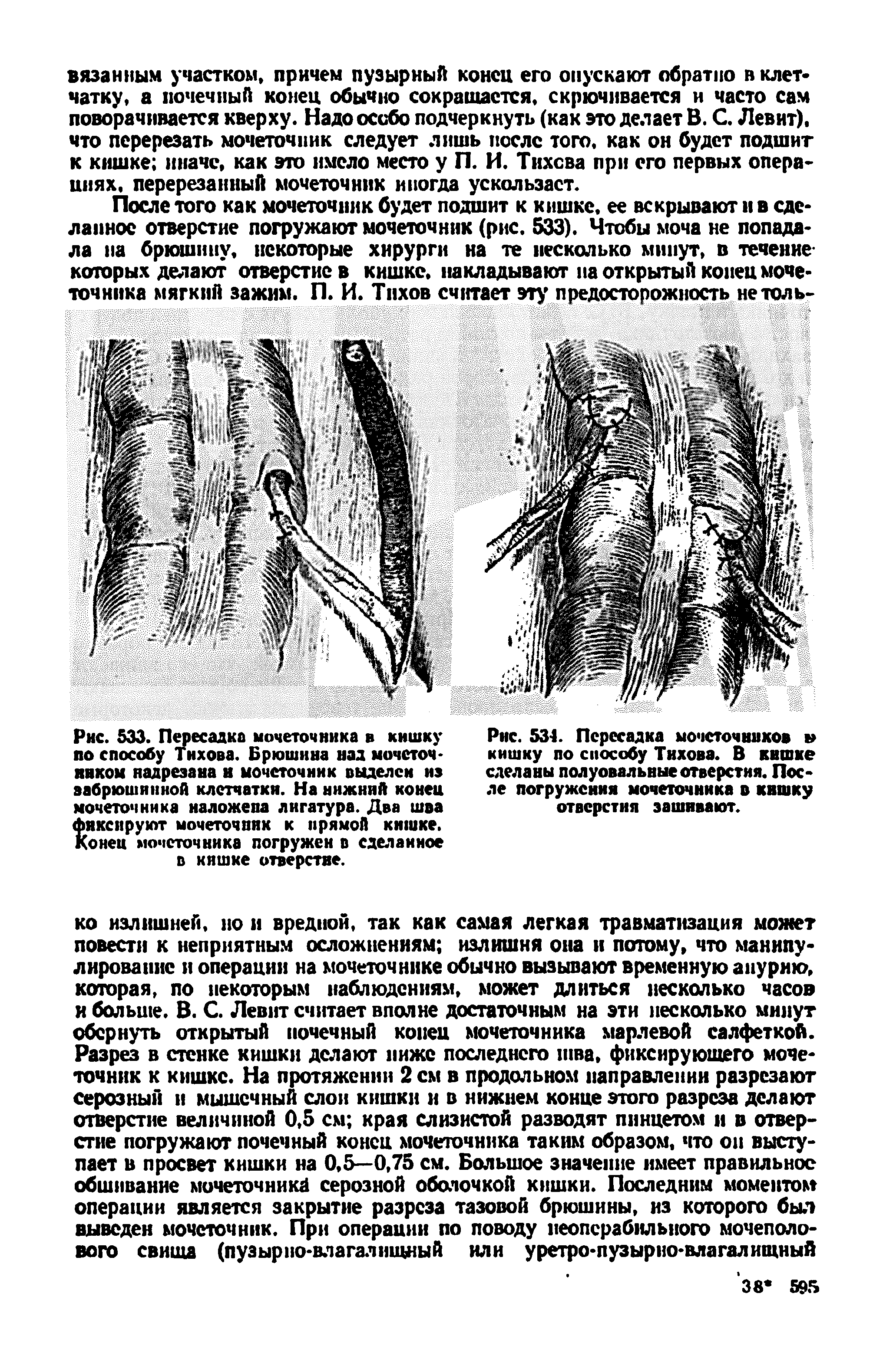 Рис. 533. Пересадка мочеточника в кишку по способу Тнхова. Брюшина над мочеточником надрезана к мочеточник выделен из забрюшинной клетчатки. На нижний конец мочеточника наложена лигатура. Два шва фиксируют мочеточник к прямой кишке. Конец мочеточника погружен в сделанное...