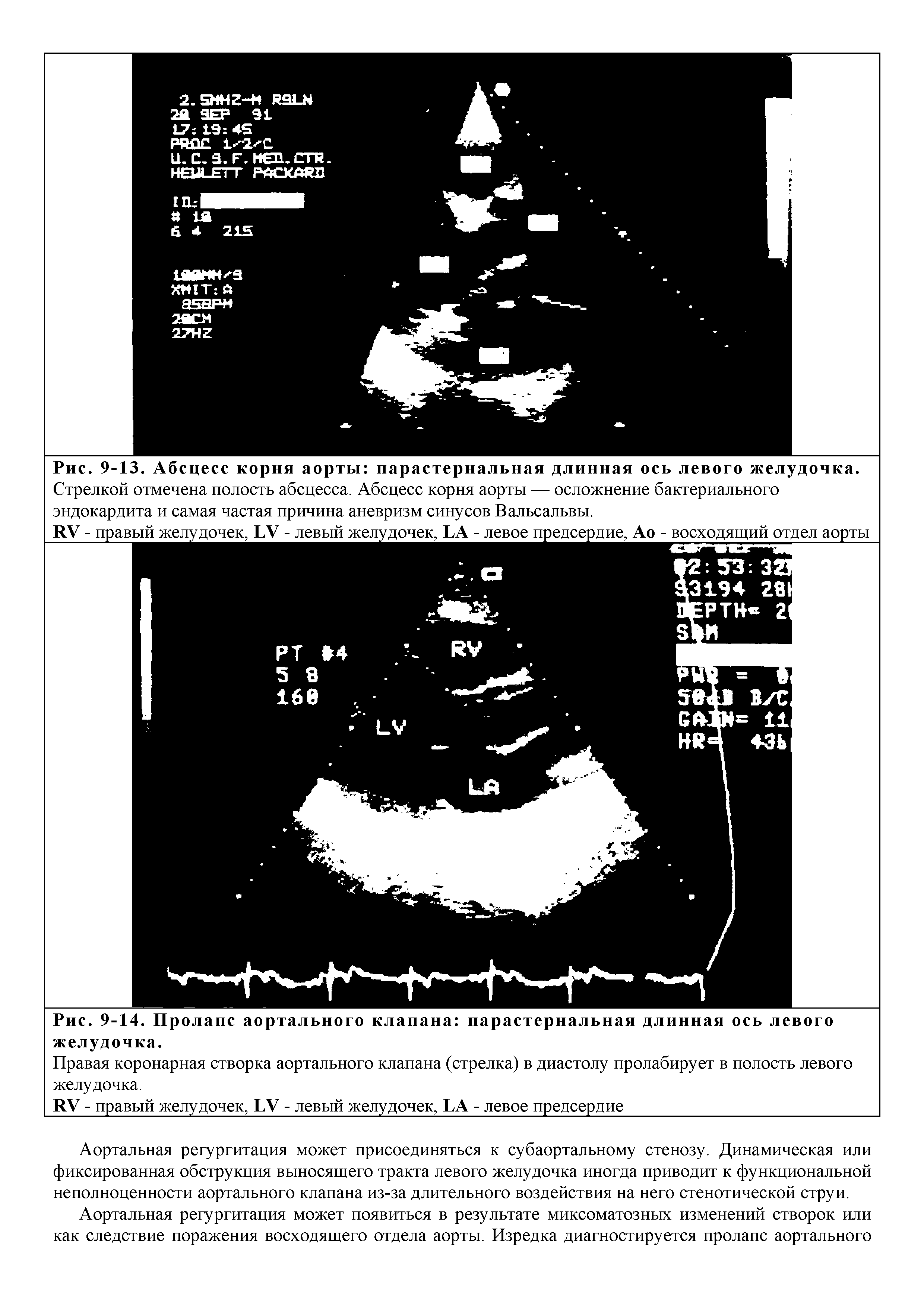 Рис. 9-14. Пролапс аортального клапана парастернальная длинная ось левого...