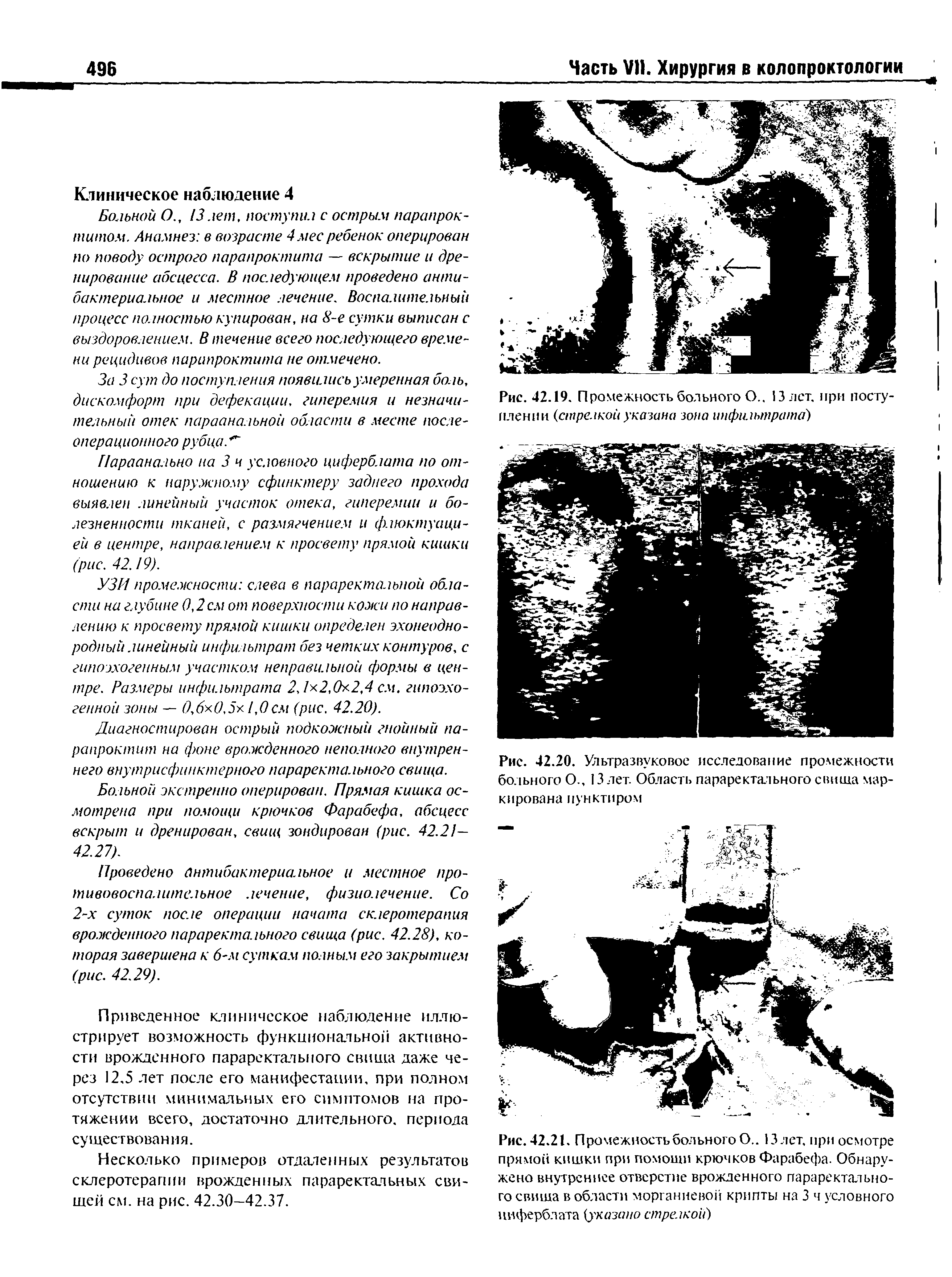 Рис. 42.20. Ультразвуковое исследование промежности больного О., 13 лет. Область параректального свища маркирована пунктиром...