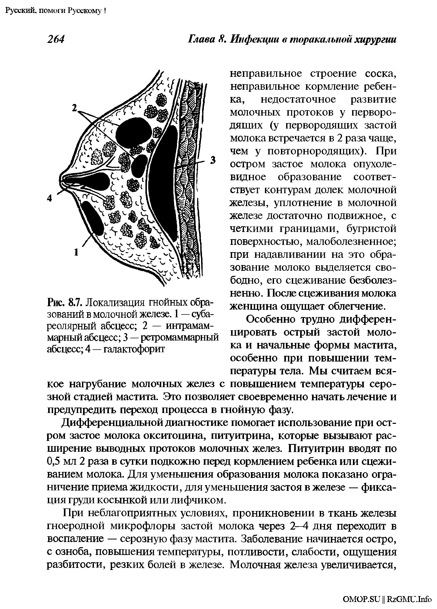 Рис. 8.7. Локализация гнойных образований в молочной железе. 1 — субареолярный абсцесс 2 — интрамам-марный абсцесс 3 — ретромаммарный абсцесс 4 — галактофорит...