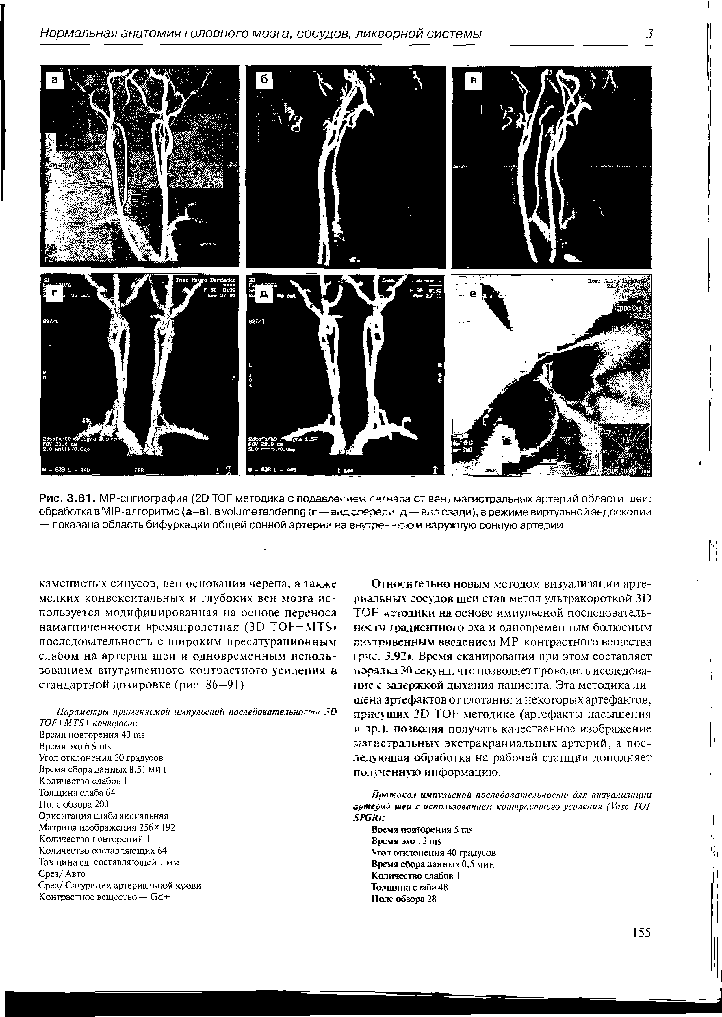 Рис. 3.81. МР-ангиография (2D TOF методика с подавлением сигнала с- вен) магистральных артерий области шеи обработка в MIP-алгоритме ( -в), в (г — влд спереди, д — вид сзади), в режиме виртульной эндоскопии — показана область бифуркации общей сонной артерии на внутре--ю<ои наружную сонную артерии.