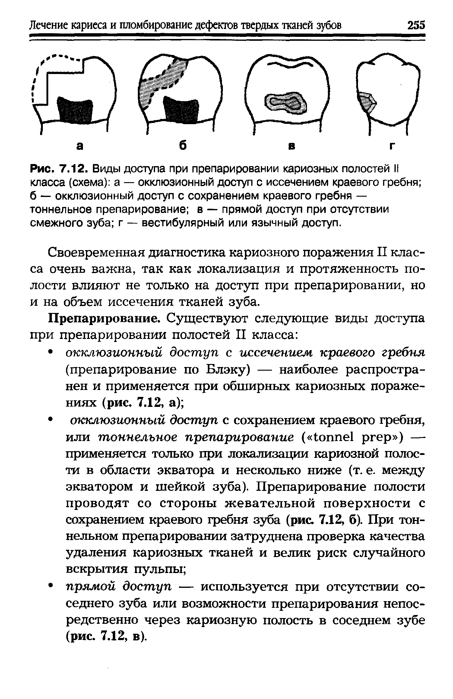 Рис. 7.12. Виды доступа при препарировании кариозных полостей II класса (схема) а — окклюзионный доступ с иссечением краевого гребня б — окклюзионный доступ с сохранением краевого гребня — тоннельное препарирование в — прямой доступ при отсутствии смежного зуба г — вестибулярный или язычный доступ.