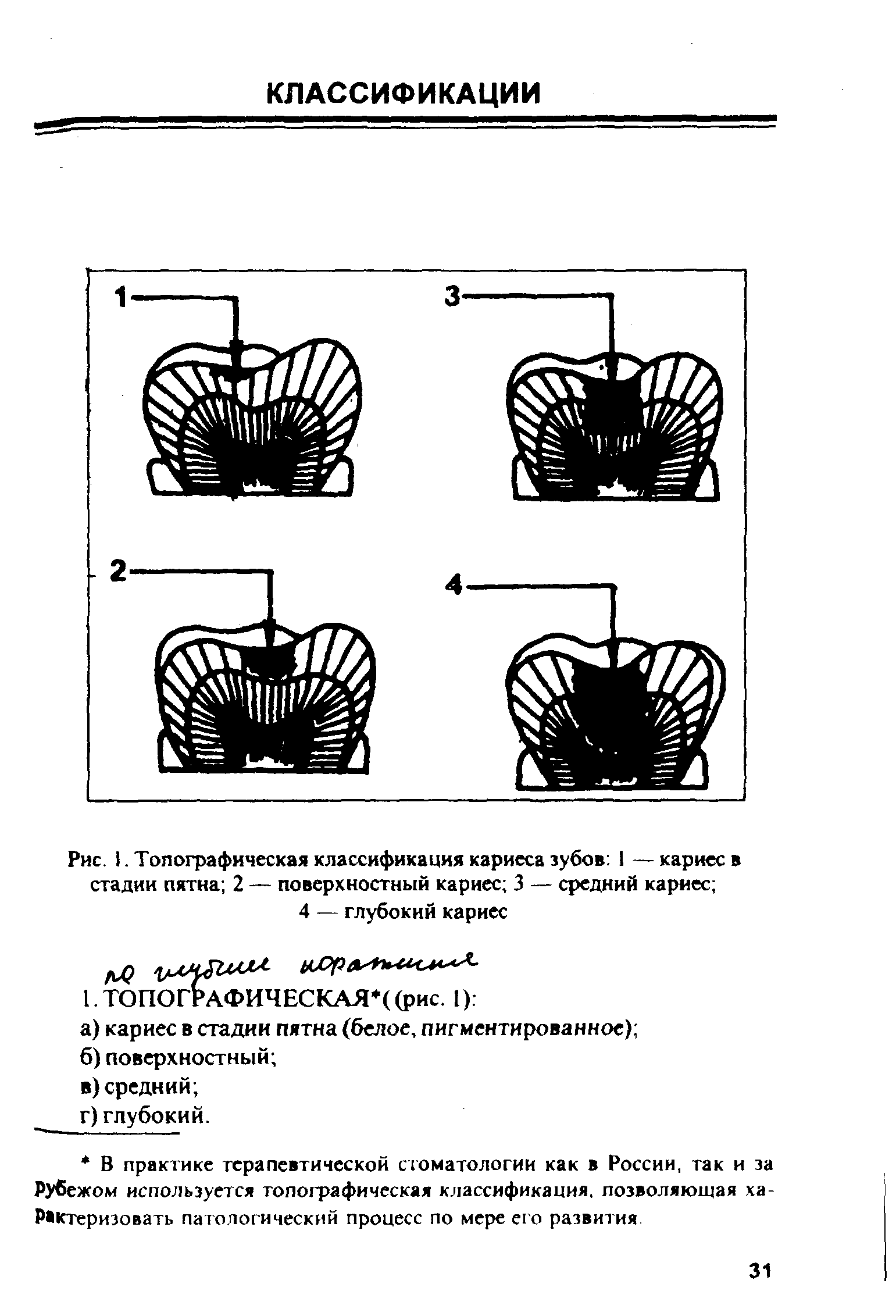 Рис. I. Топографическая классификация кариеса зубов 1 — кариес в стадии пятна 2 — поверхностный кариес 3 — средний кариес 4 — глубокий кариес...