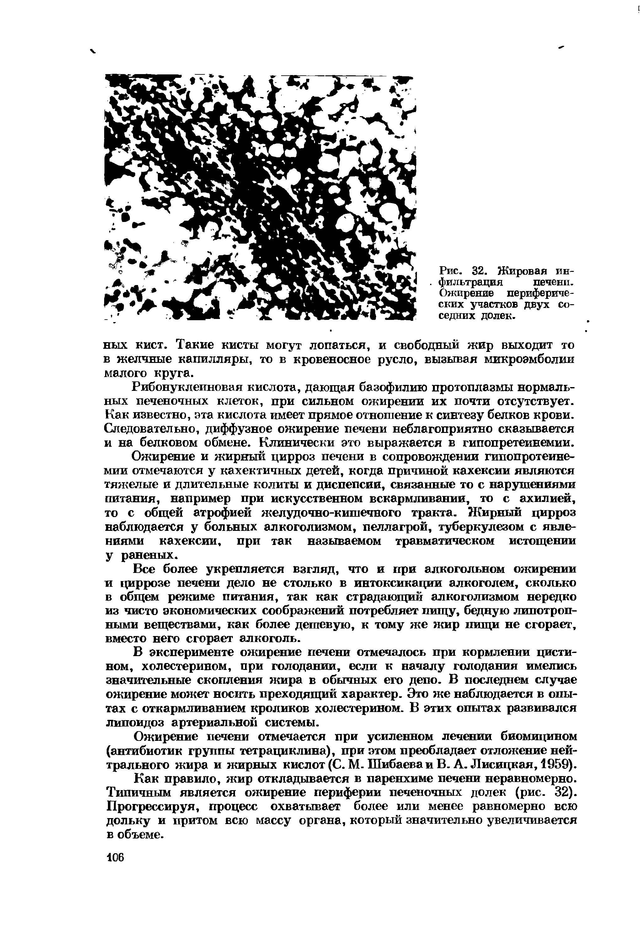 Рис. 32. Жировая инфильтрация печени. Ожирение периферических участков двух соседних долек.