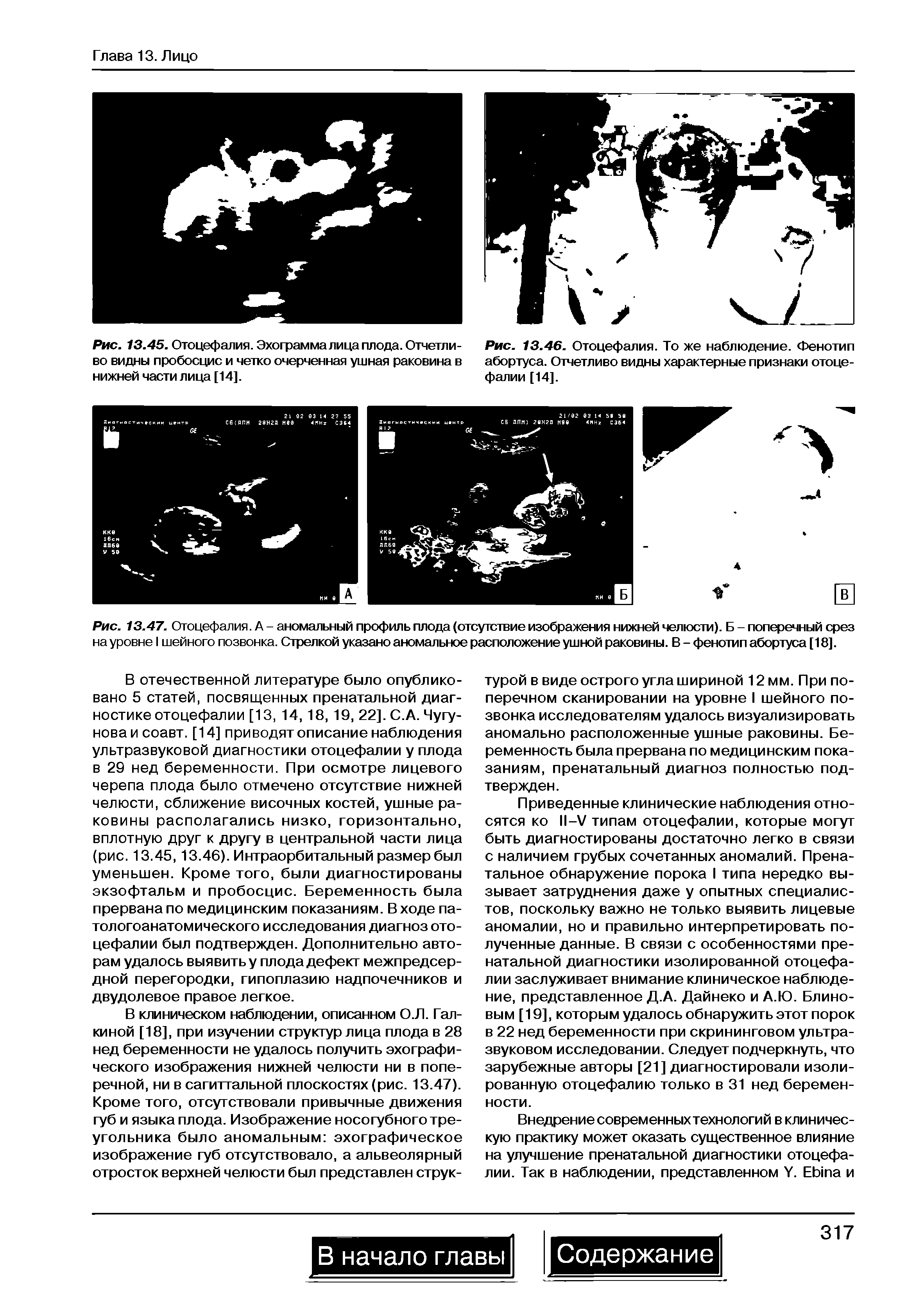 Рис. 13.46. Отоцефалия. То же наблюдение. Фенотип абортуса. Отчетливо видны характерные признаки отоцефалии [14].