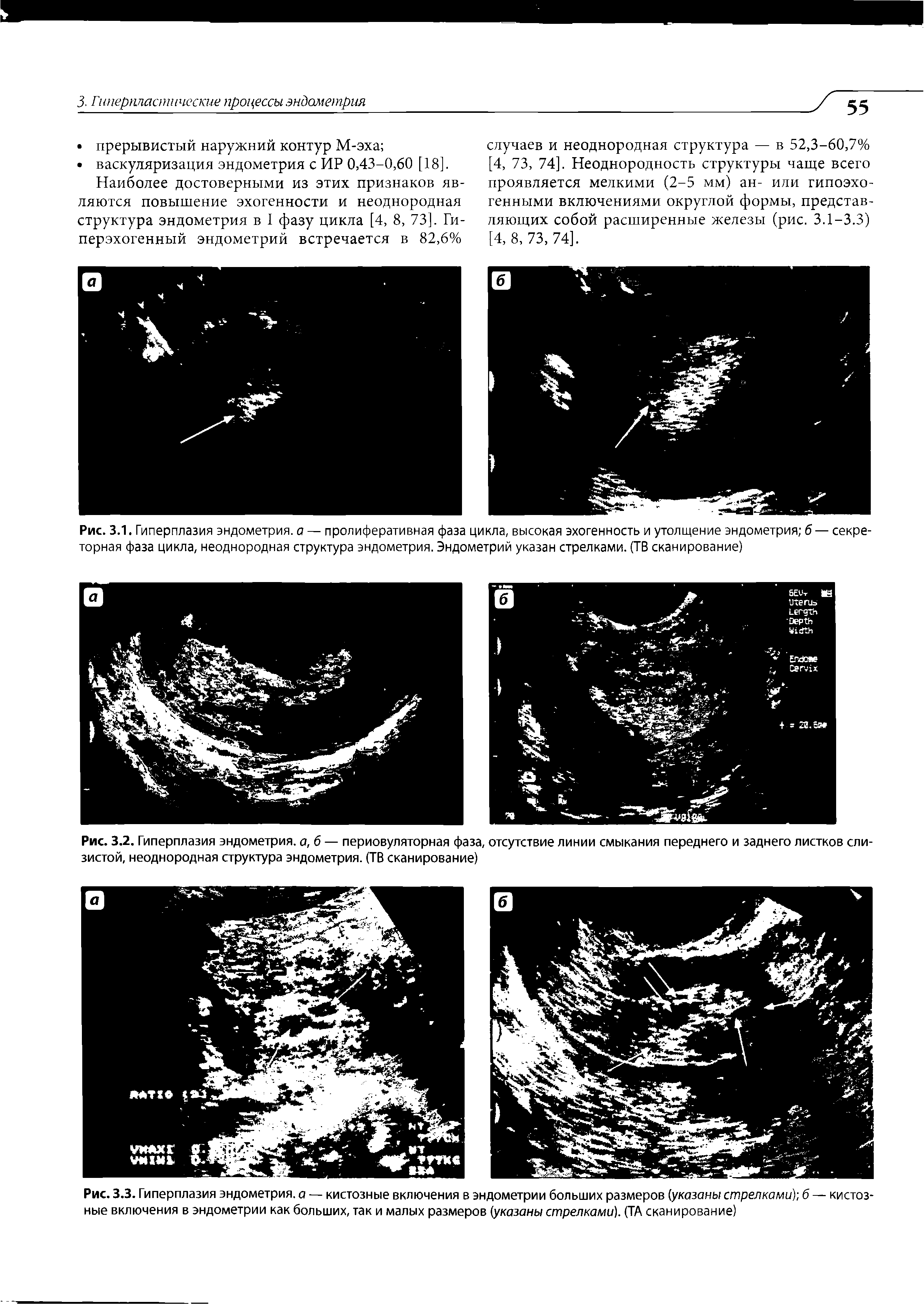 Рис. 3.3. Гиперплазия эндометрия, а — кистозные включения в эндометрии больших размеров (указаны стрелками) б — кистозные включения в эндометрии как больших, так и малых размеров (указаны стрелками). (ТА сканирование)...