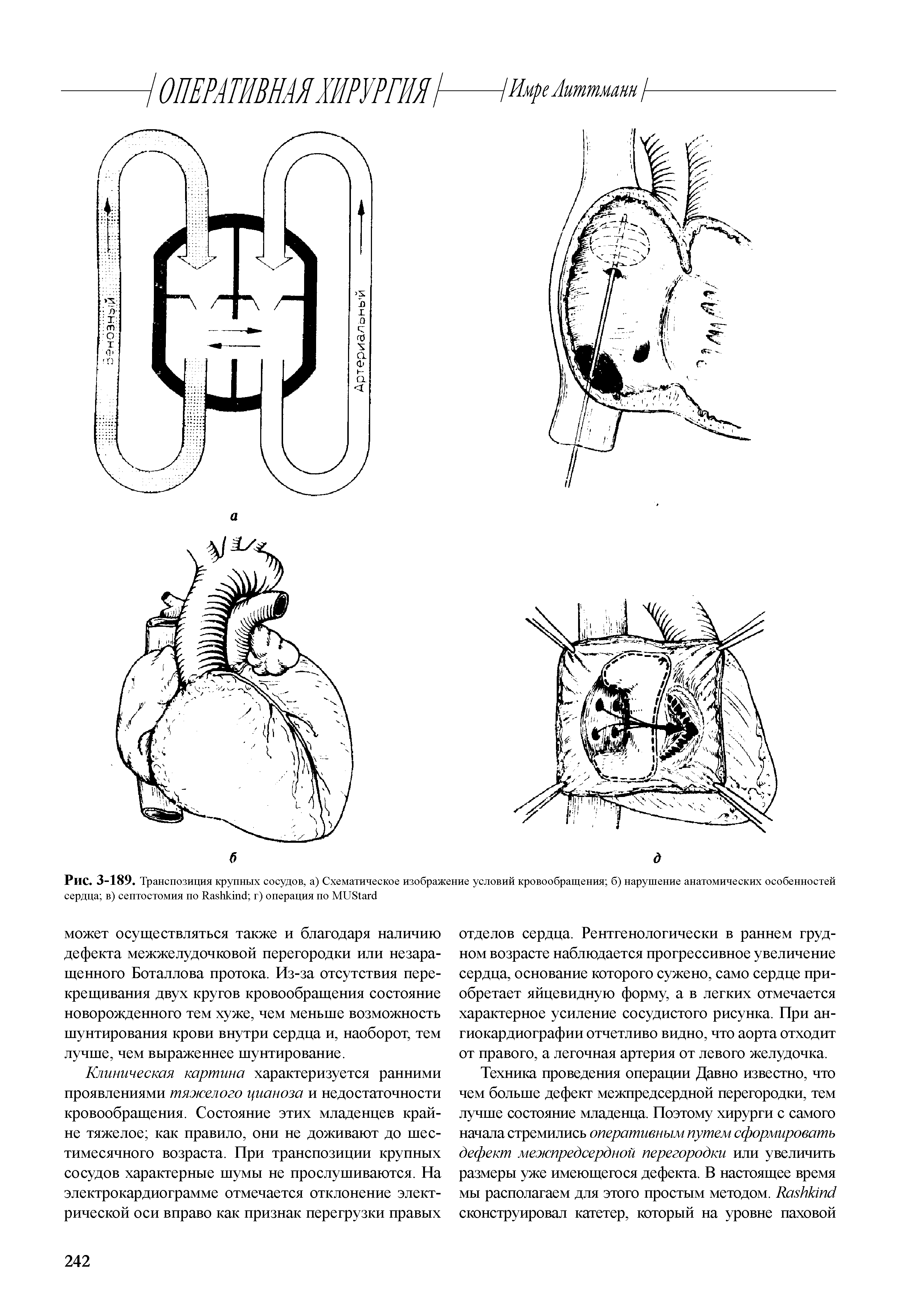 Рис. 3-189. Транспозиция крупных сосудов, а) Схематическое изображение условий кровообращения б) нарушение анатомических особенностей сердца в) септостомия по Иавйктс г) операция по H S ...