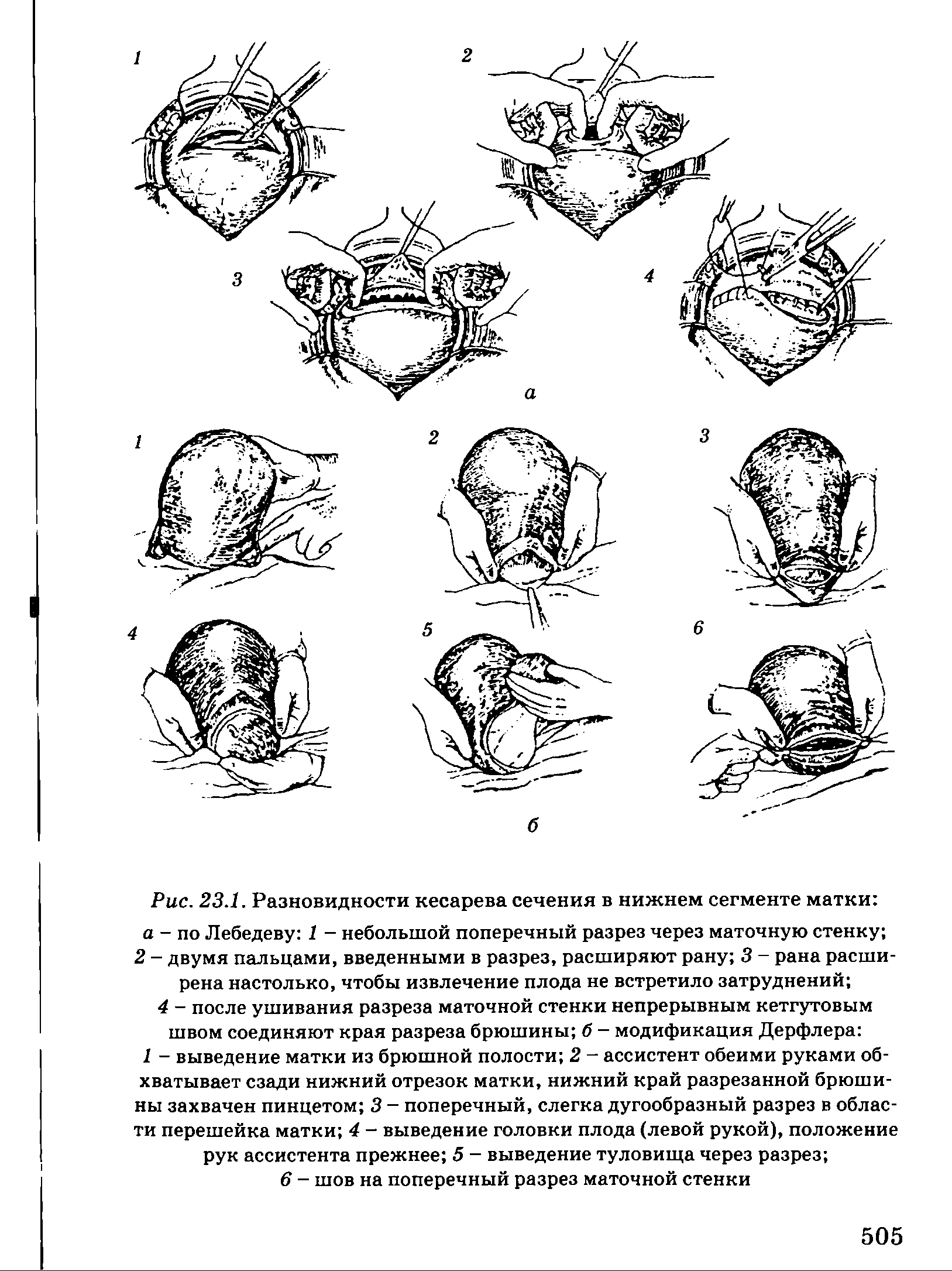 Рис. 23.1. Разновидности кесарева сечения в нижнем сегменте матки а - по Лебедеву 1 — небольшой поперечный разрез через маточную стенку 2 - двумя пальцами, введенными в разрез, расширяют рану 3 - рана расширена настолько, чтобы извлечение плода не встретило затруднений ...