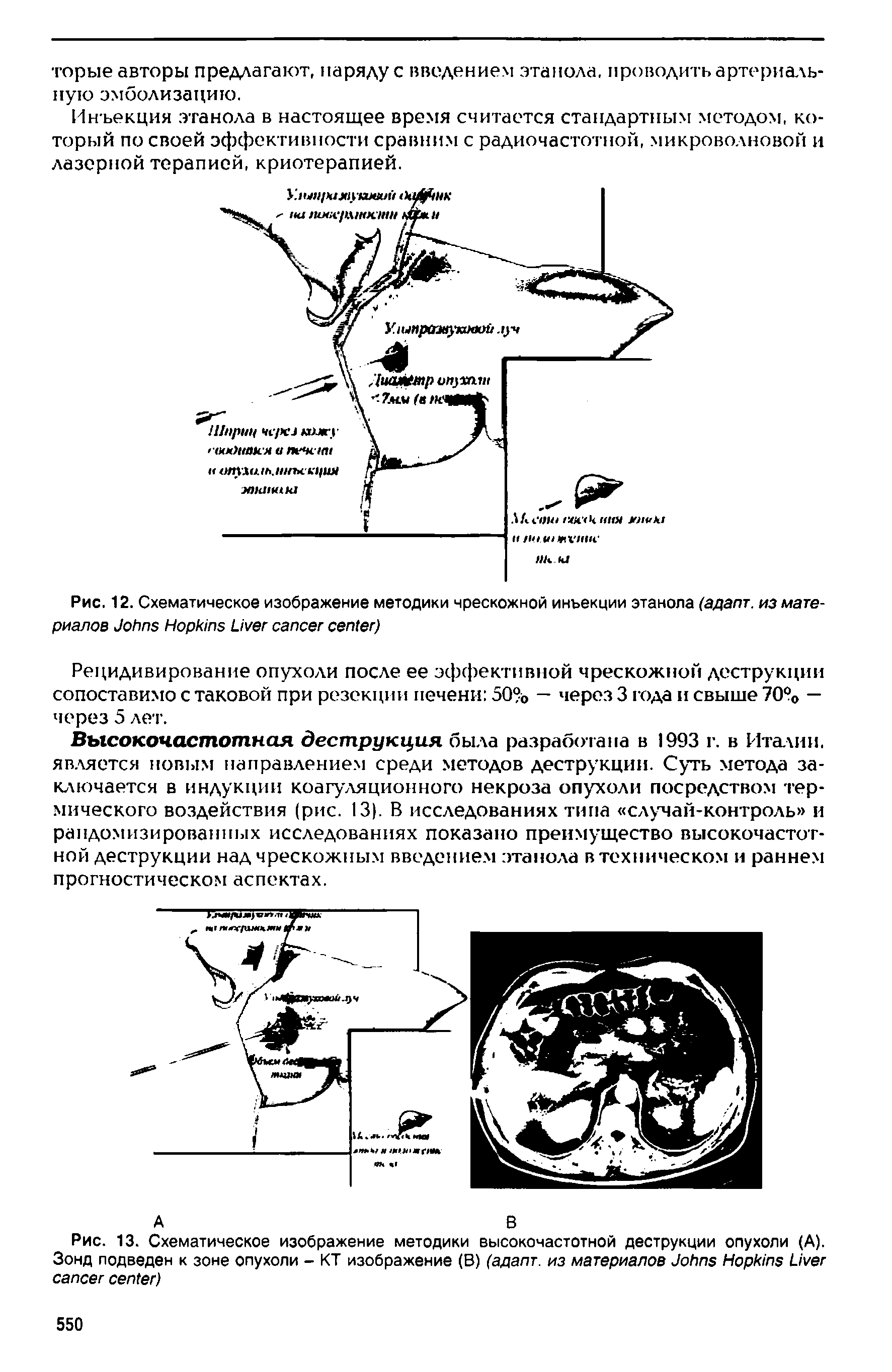Рис. 12. Схематическое изображение методики чрескожной инъекции этанола (адапт. из материалов J H L )...
