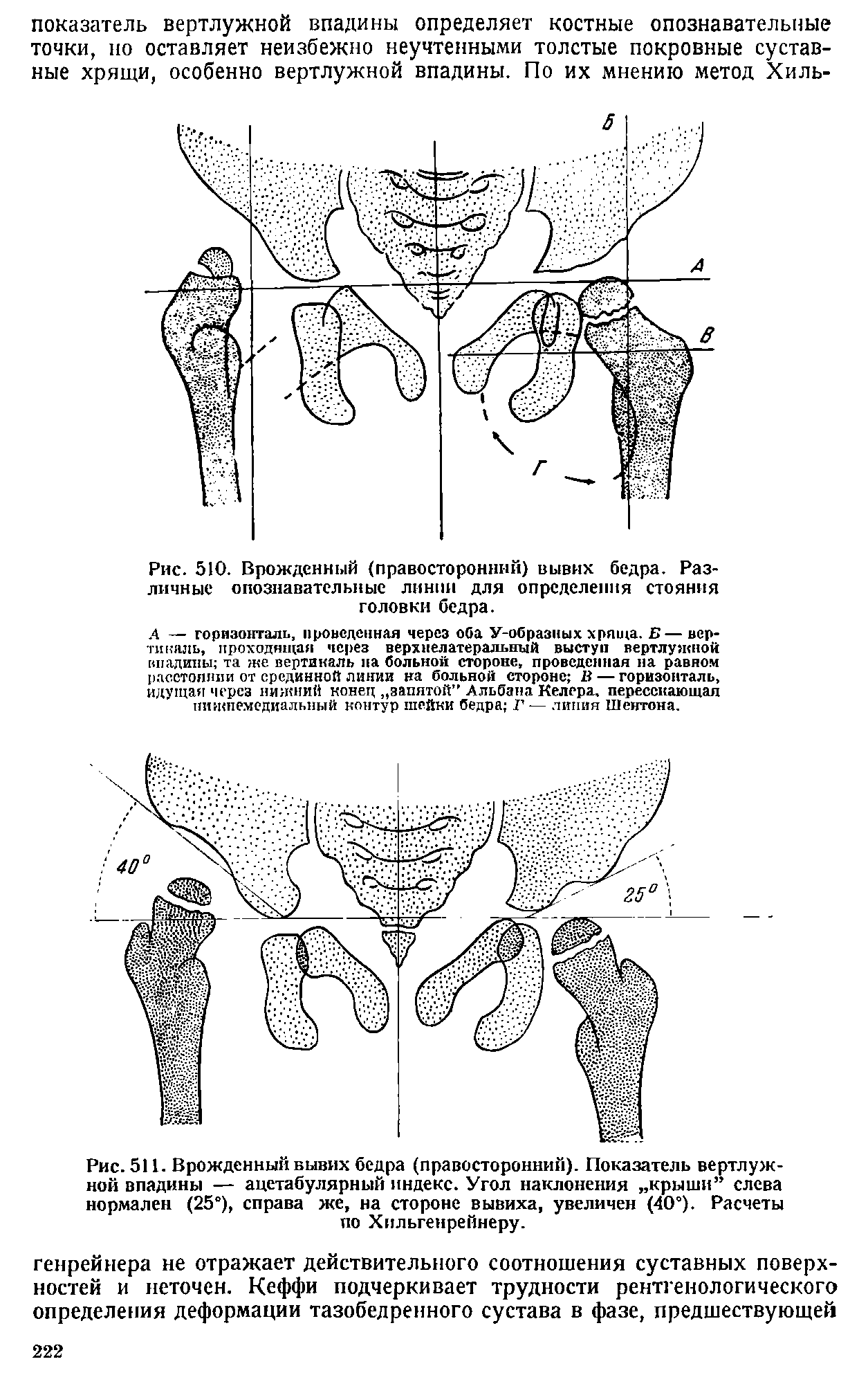Рис. 511. Врожденный вывих бедра (правосторонний). Показатель вертлужной впадины — ацетабулярный индекс. Угол наклонения крыши слева нормален (25°), справа же, на стороне вывиха, увеличен (40°). Расчеты по Хильгенрейнеру.