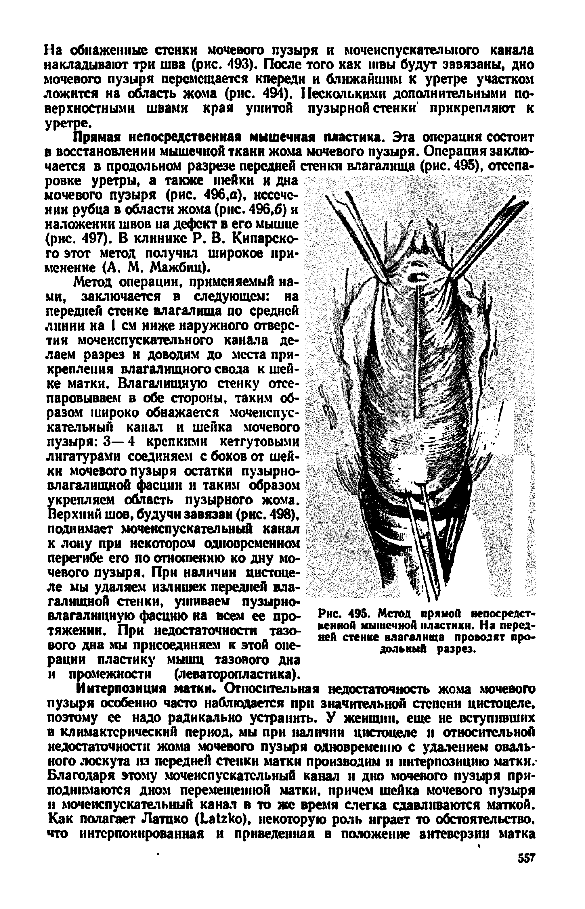 Рис. 495. Метод прямой непосредственной мышечной пластики. На передней стенке влагалища проводят продольный разрез.