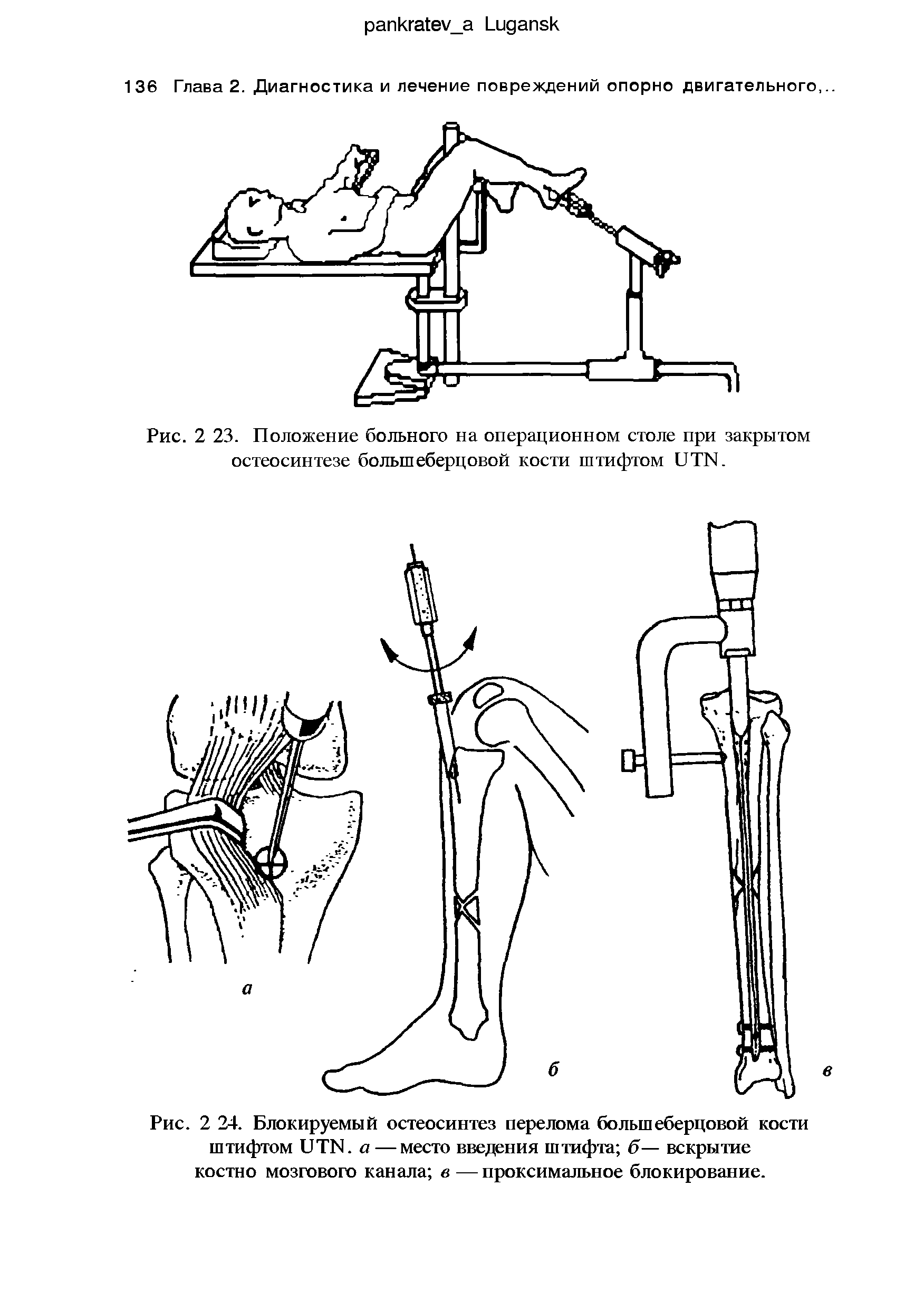 Рис. 2 24. Блокируемый остеосинтез перелома большеберцовой кости штифтом и ТЫ. а — место введения штифта б— вскрытие костно мозгового канала в —проксимальное блокирование.