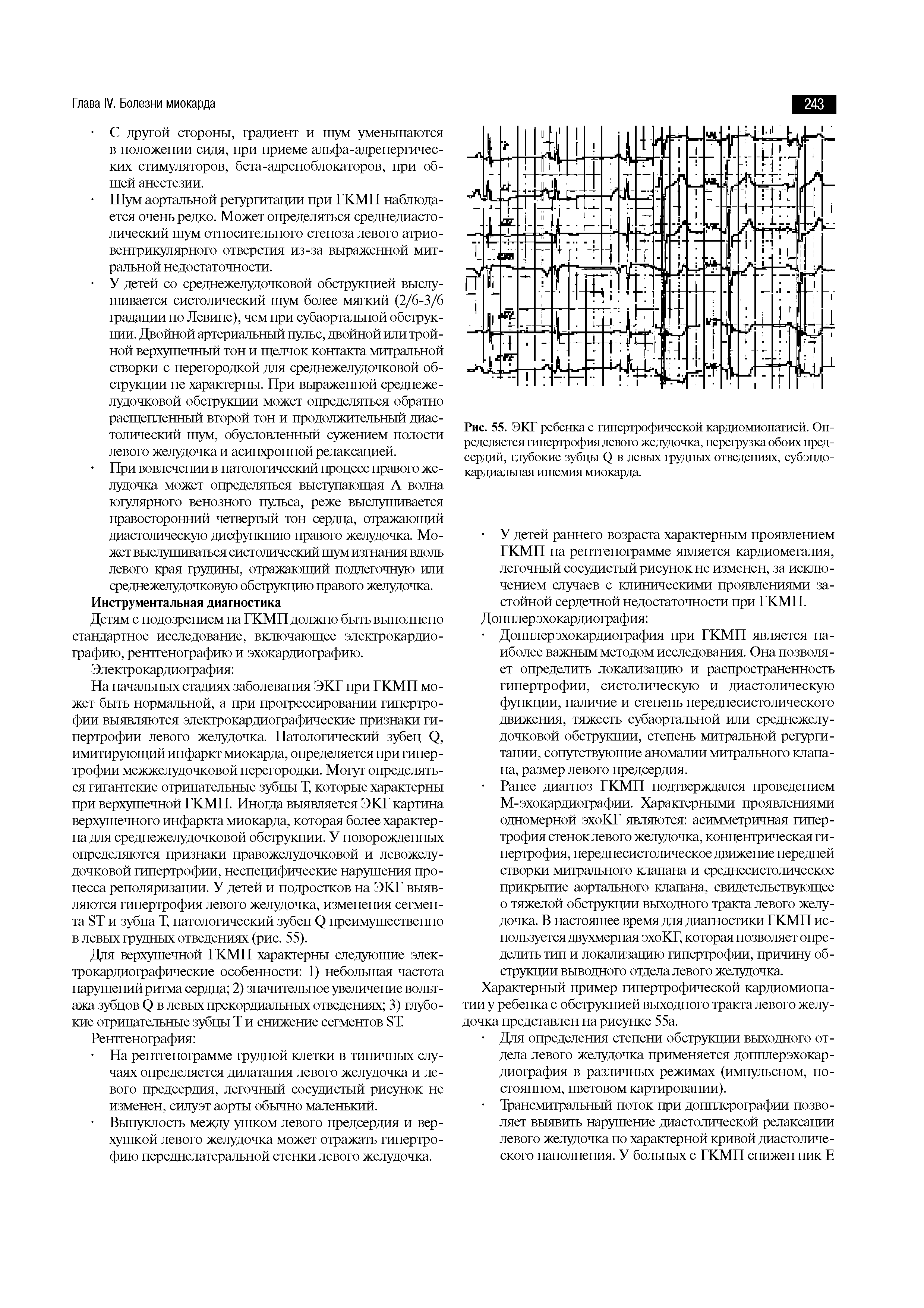 Рис. 55. ЭКГ ребенка с гипертрофической кардиомиопатией. Определяется гипертрофия левого желудочка, перегрузка обоих предсердий, глубокие зубцы ф в левых грудных отведениях, субэндокардиальная ишемия миокарда.