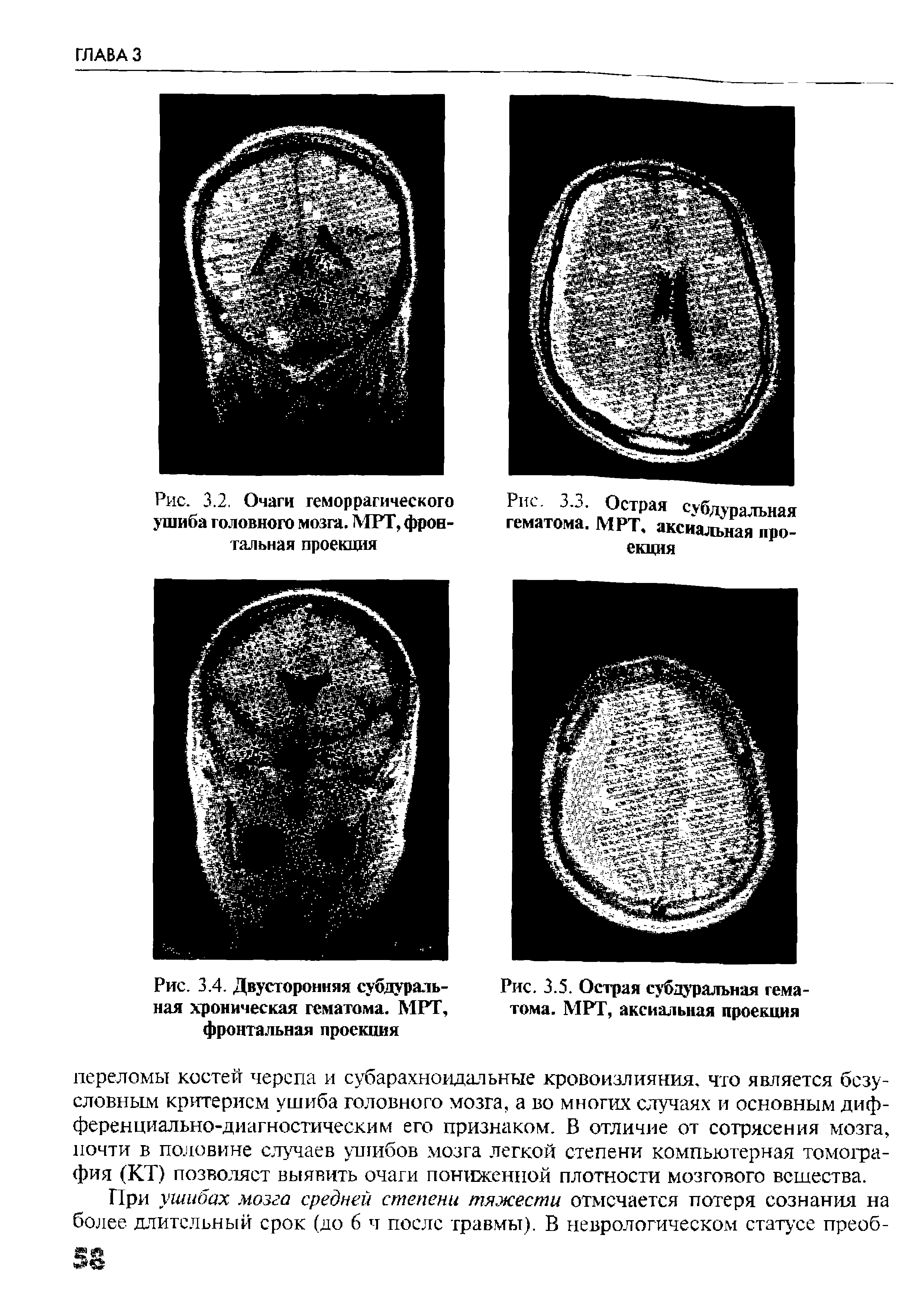 Рис. 3.4. Двусторонняя субдуральная хроническая гематома. МРТ, фронтальная проекция...