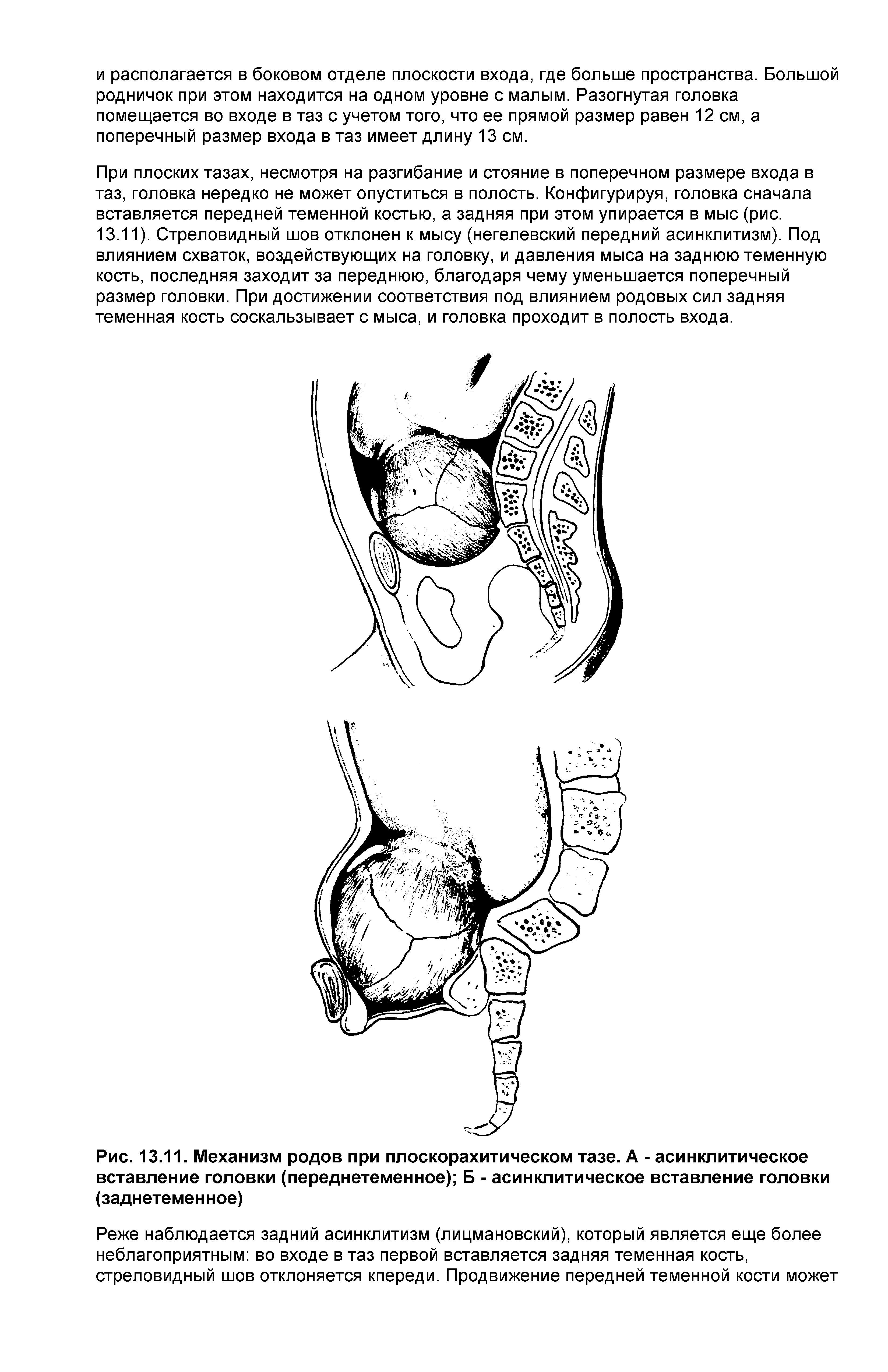 Рис. 13.11. Механизм родов при плоскорахитическом тазе. А - асинклитическое вставление головки (переднетеменное) Б - асинклитическое вставление головки (заднетемен ное)...