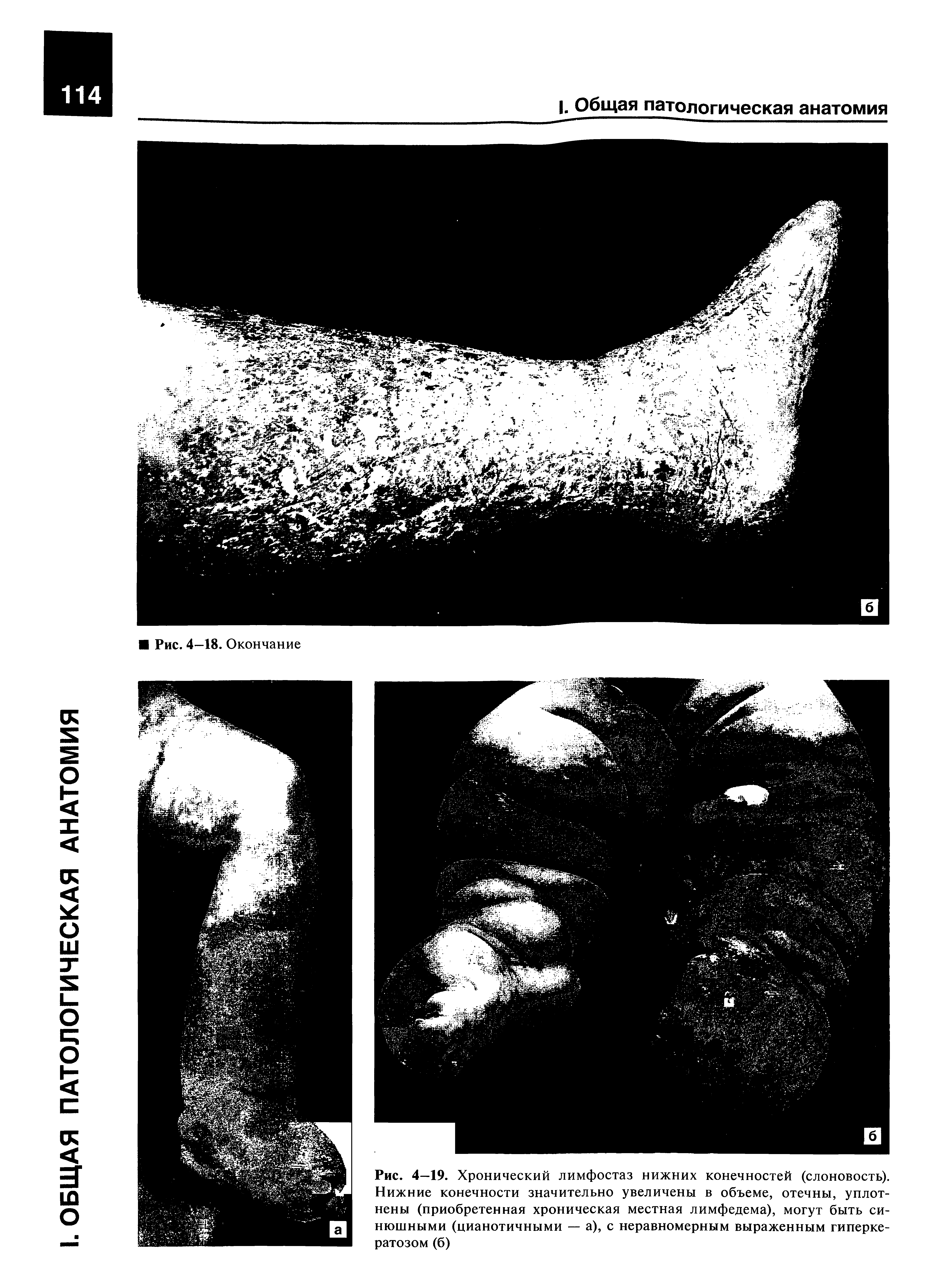 Рис. 4—19. Хронический лимфостаз нижних конечностей (слоновость). Нижние конечности значительно увеличены в объеме, отечны, уплотнены (приобретенная хроническая местная лимфедема), могут быть синюшными (цианотичными — а), с неравномерным выраженным гиперкератозом (б)...