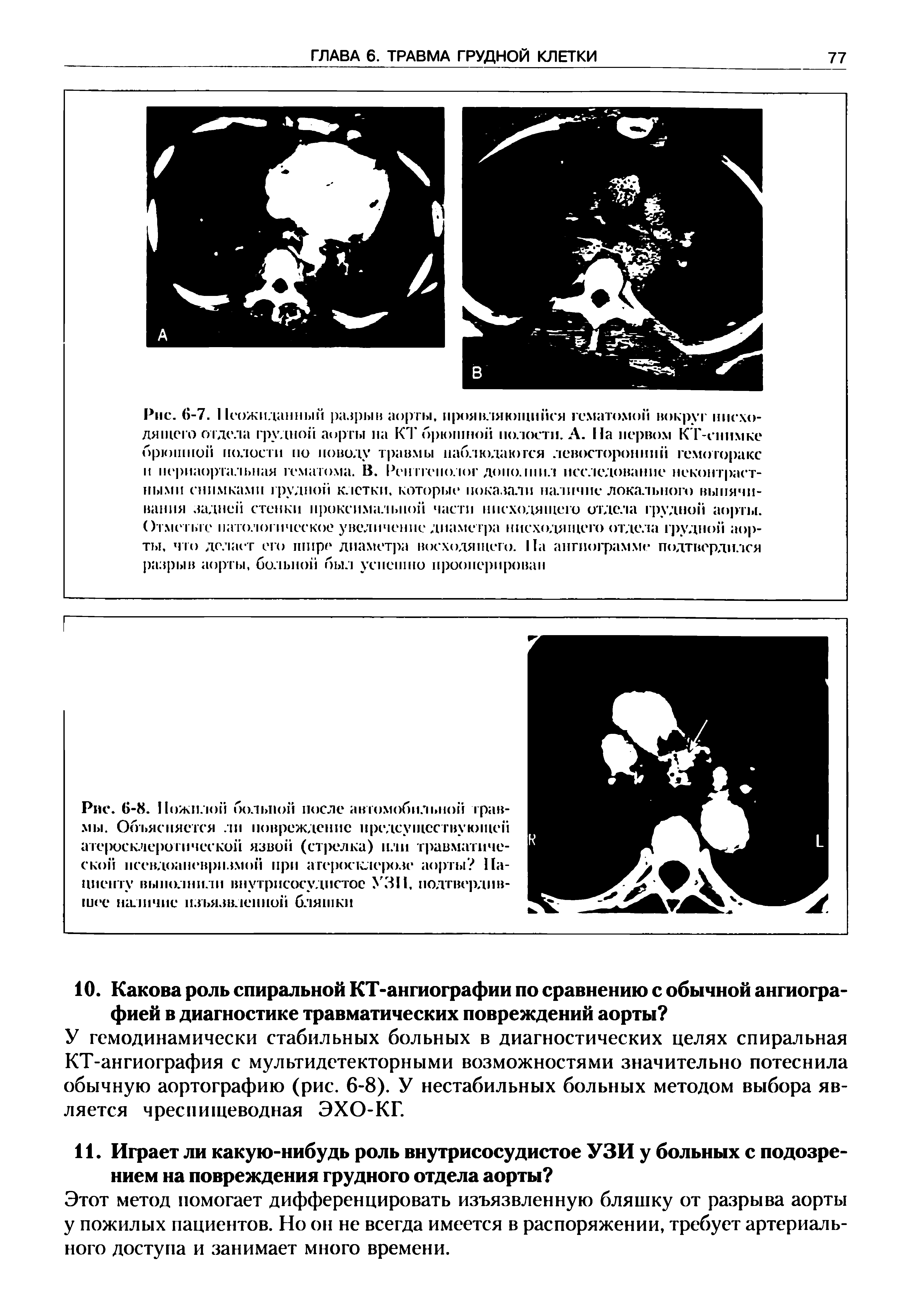 Рис. 6-8. Пожилой больной после автомобильной травмы. Объясняется ли повреждение предсу шествую щеп атеросклеротической язвой (стрелка) пли травматической псевдоаневризмой при атеросклерозе аорты Пациенту выполнили внутрисосудистое > 311, подтвердившее наличие нзъязвленной бляшки...
