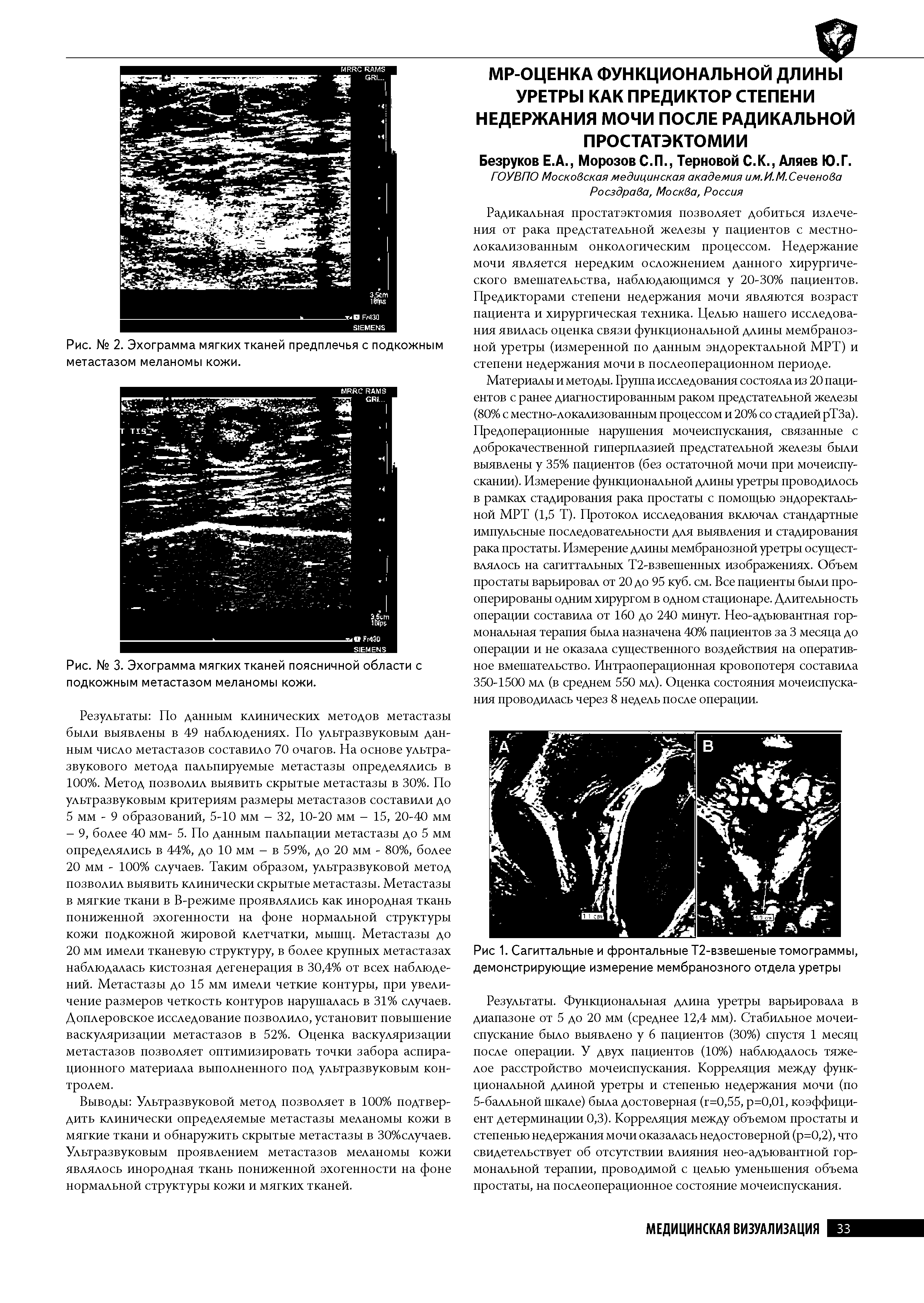 Рис. № 3. Эхограмма мягких тканей поясничной области с подкожным метастазом меланомы кожи.