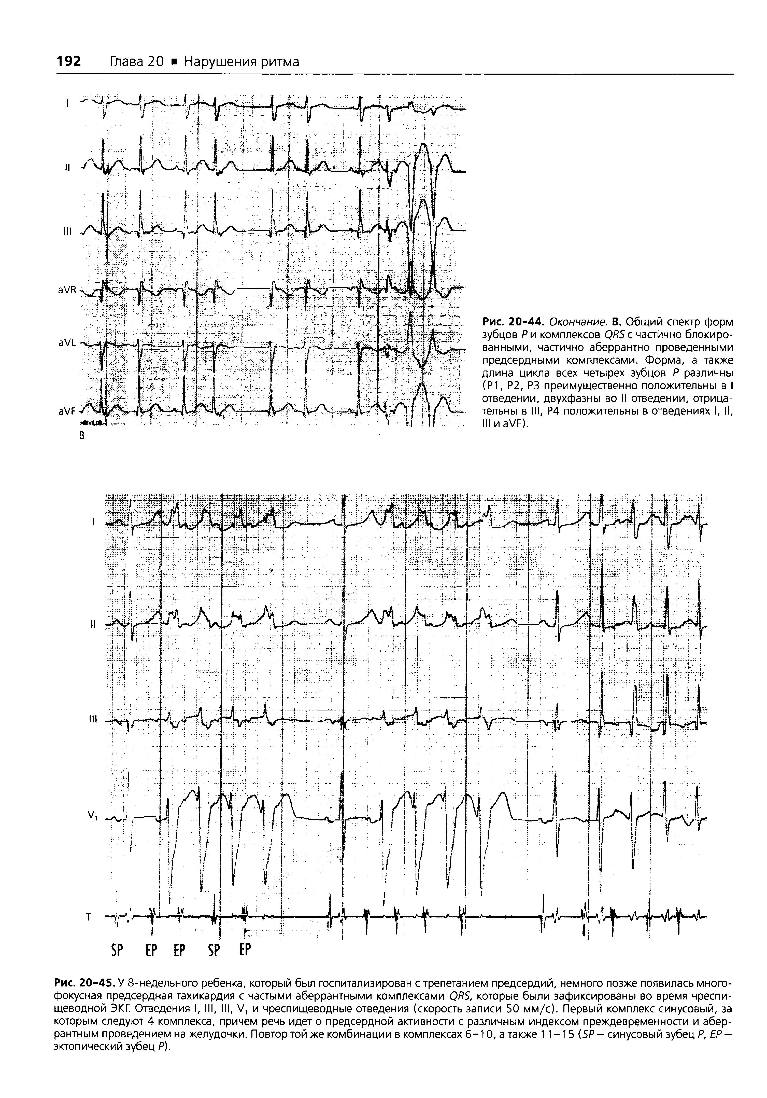 Рис. 20-44. Окончание. В. Общий спектр форм зубцов Р и комплексов QRS с частично блокированными, частично аберрантно проведенными предсердными комплексами. Форма, а также длина цикла всех четырех зубцов Р различны (Р1, Р2, РЗ преимущественно положительны в I отведении, двухфазны во II отведении, отрицательны в III, Р4 положительны в отведениях I, II, III и VF).