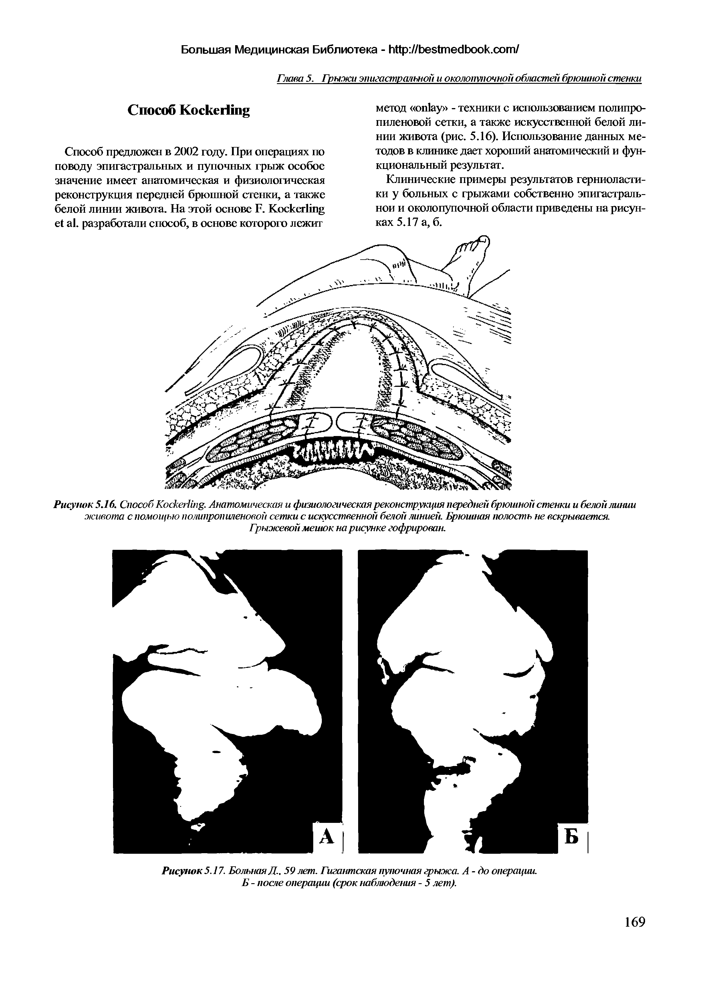 Рисунок 5.16. Способ Коскег1й1 . Анатомическая и физиологическая реконструкция передней брюшной стенки и белой линии живота с помощью полипропиленовой сетки с искусственной белой линией. Брюшная полость не вскрывается.