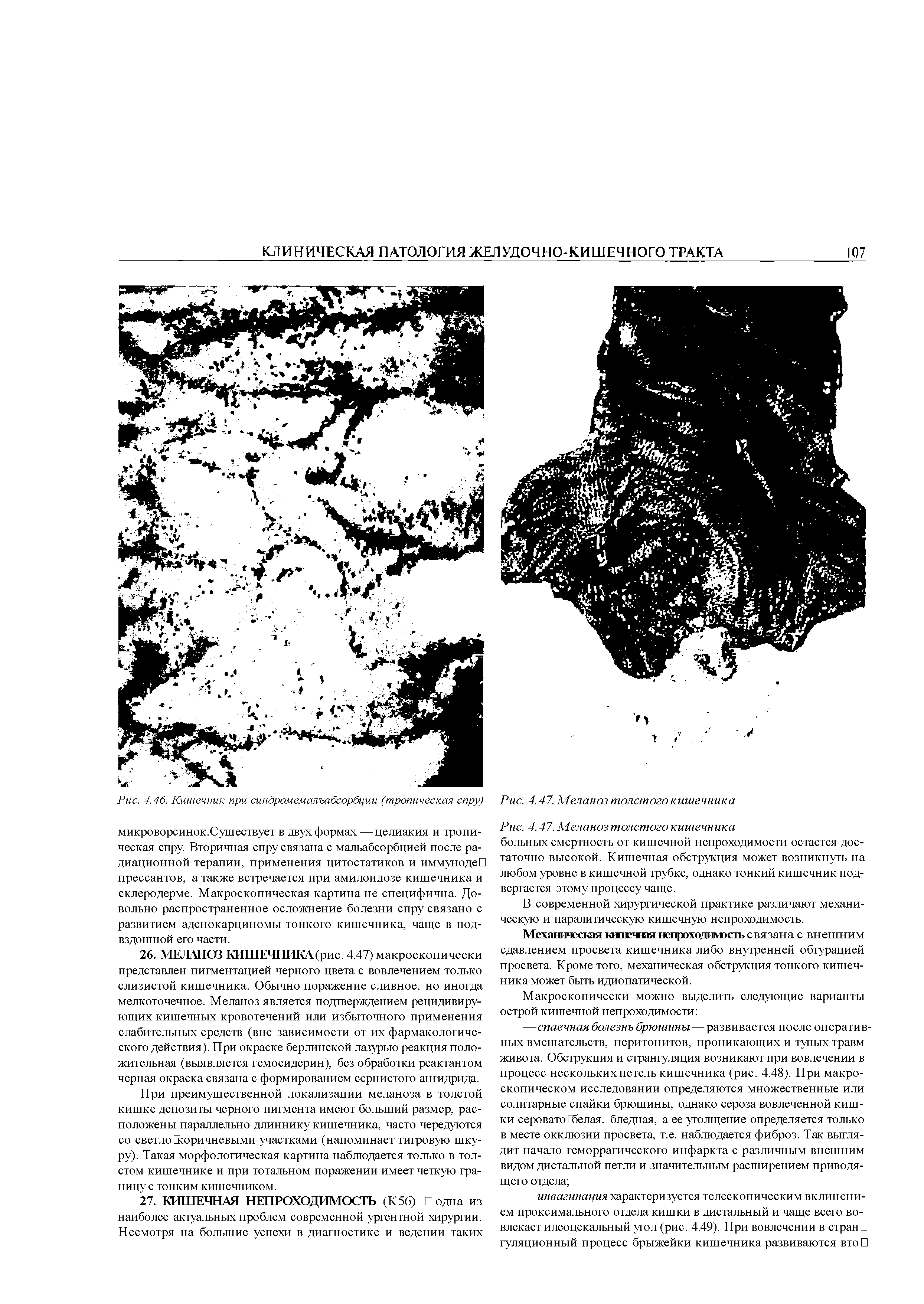 Рис. 4.47. Меланоз толстого кишечника больных смертность от кишечной непроходимости остается достаточно высокой. Кишечная обструкция может возникнуть на любом уровне в кишечной трубке, однако тонкий кишечник подвергается этому процессу чаще.