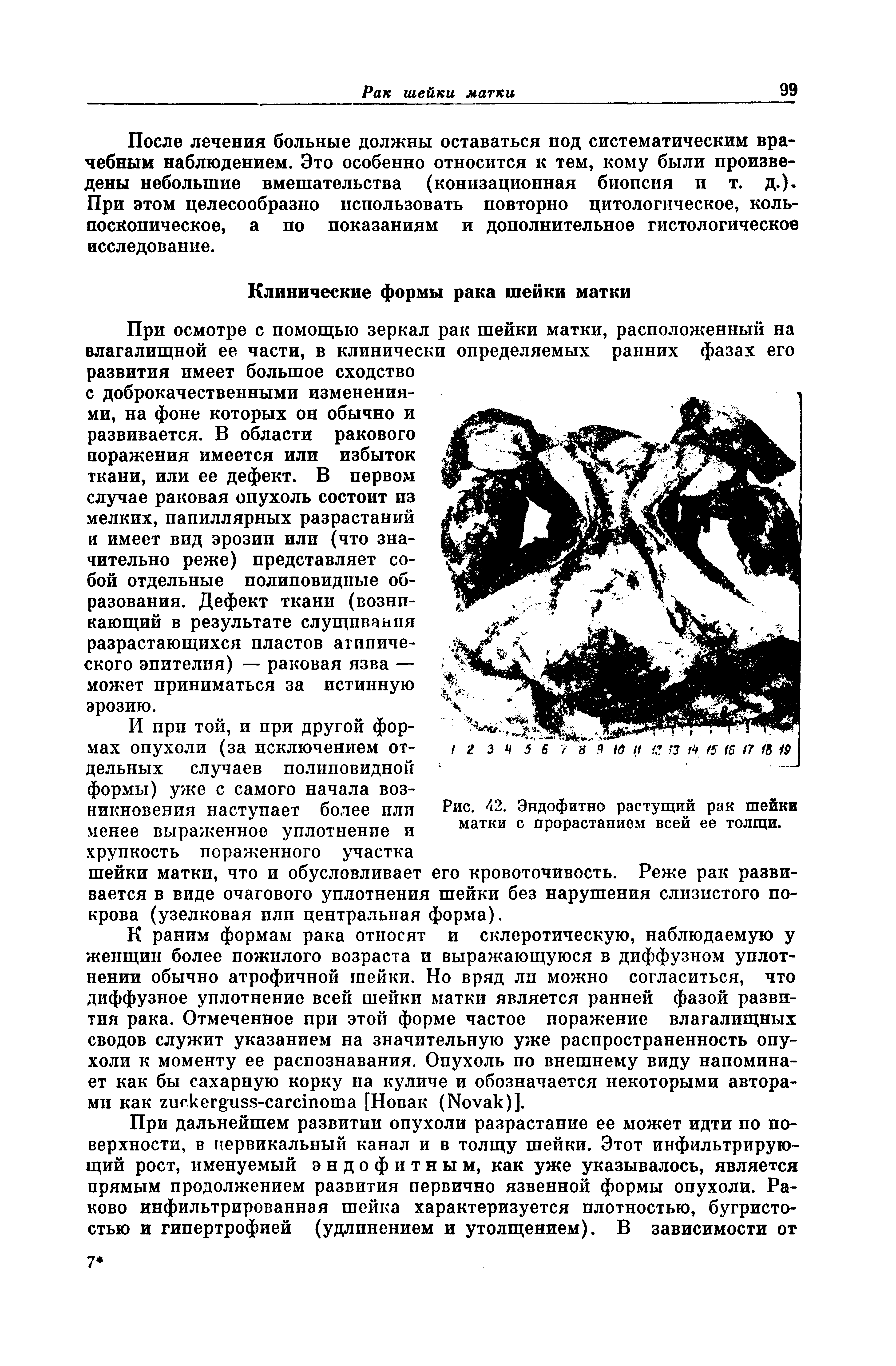 Рис. 42. Эндофитно растущий рак шейки матки с прорастанием всей ее толщи.