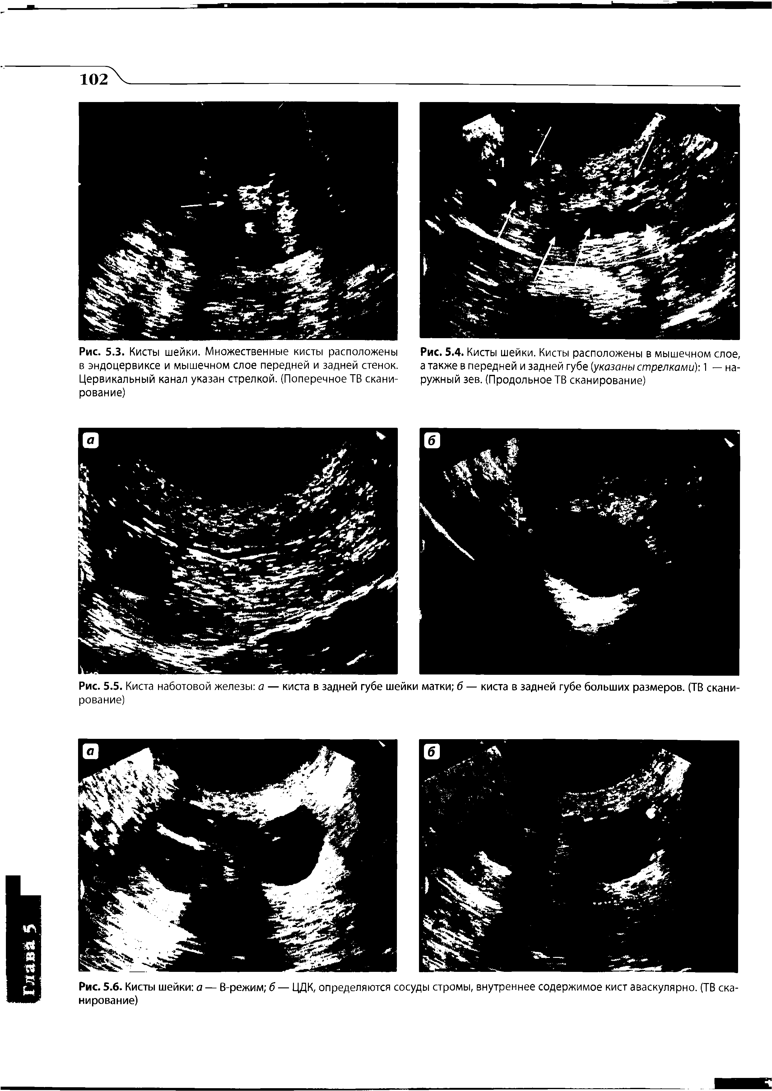 Рис. 5.6. Кисты шейки а — В-режим б — ЦДК, определяются сосуды стромы, внутреннее содержимое кист аваскулярно. (ТВ сканирование)...