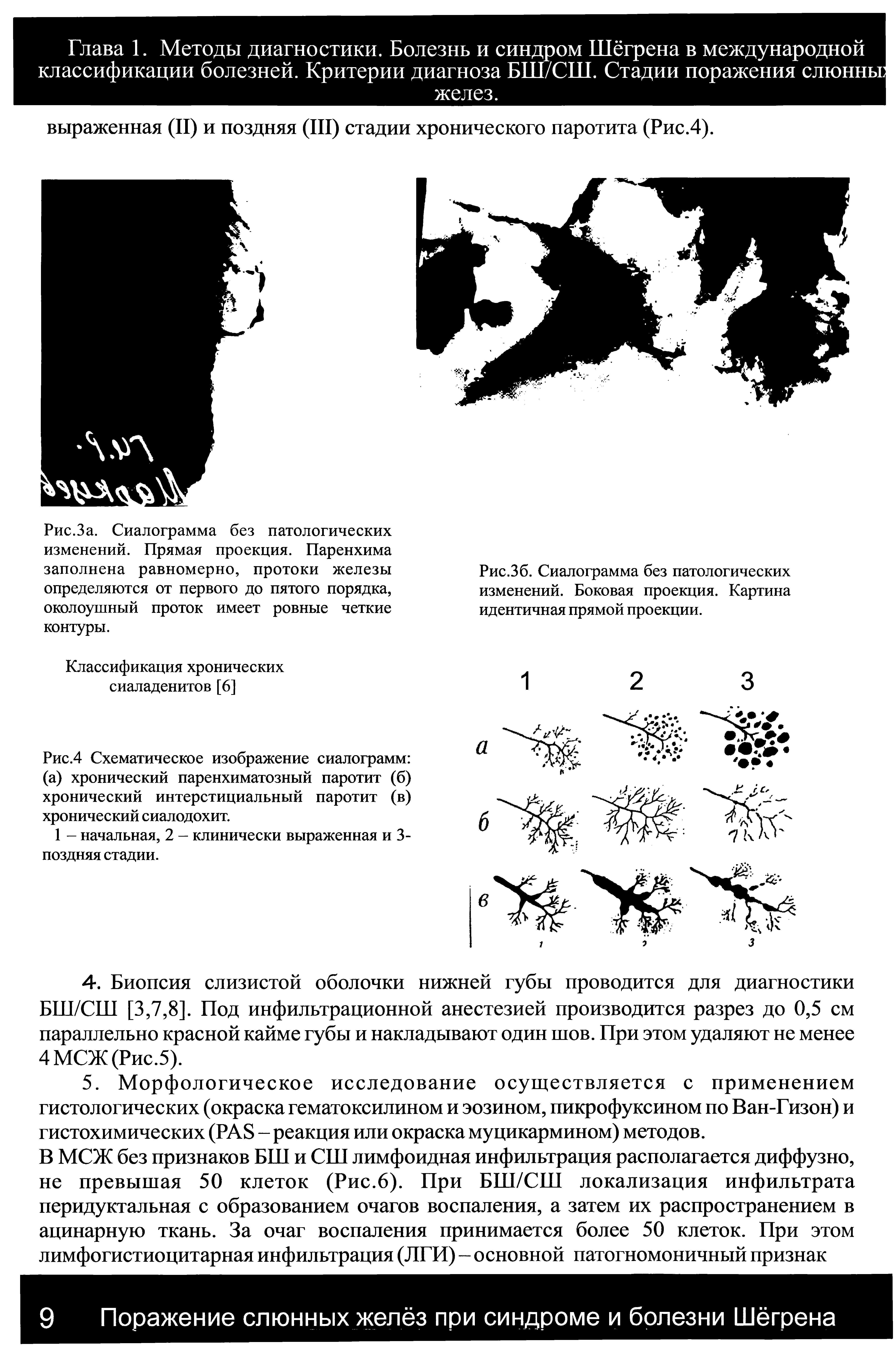 Рис.За. Сиалограмма без патологических изменений. Прямая проекция. Паренхима заполнена равномерно, протоки железы определяются от первого до пятого порядка, околоушный проток имеет ровные четкие контуры.