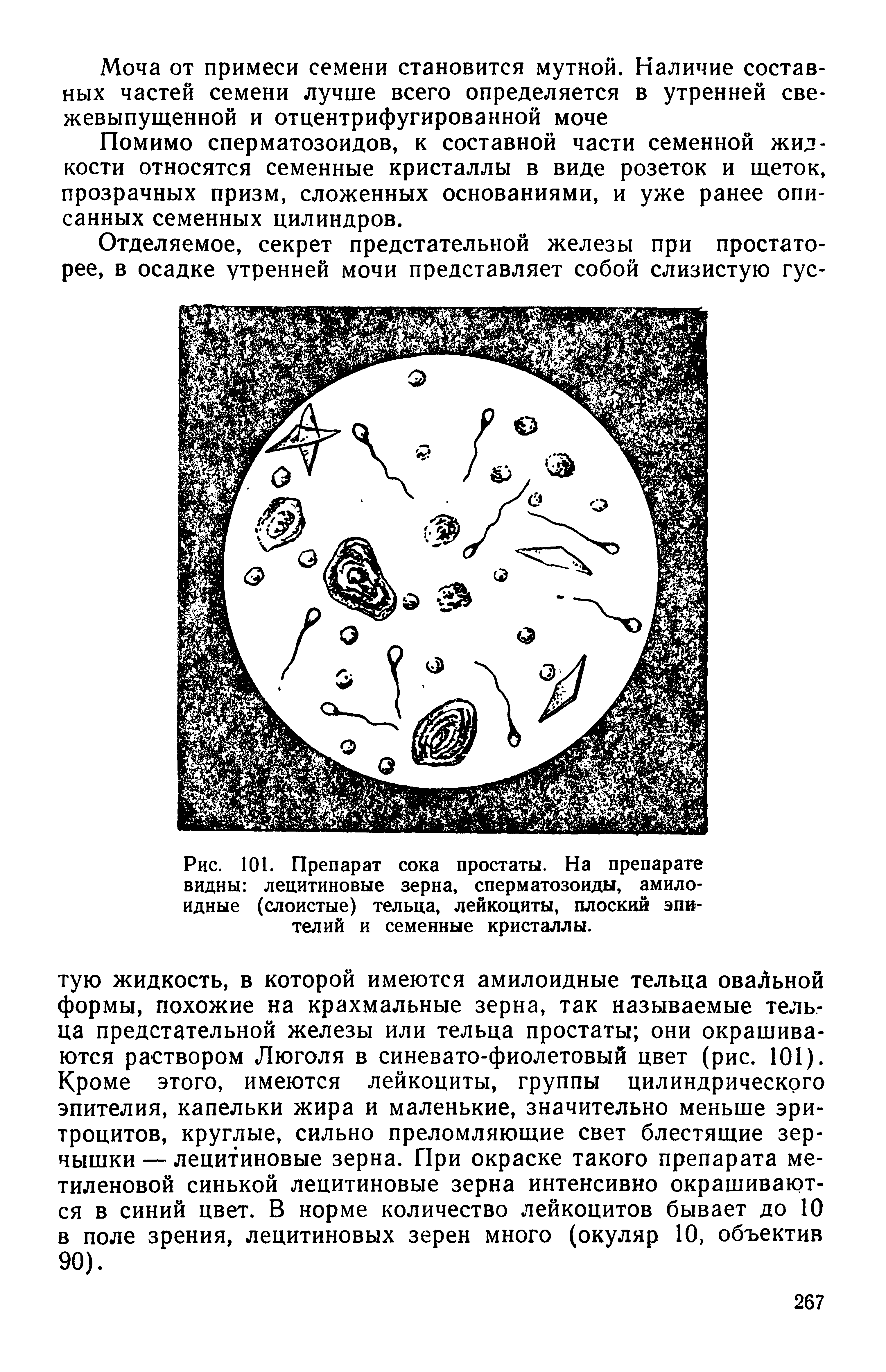 Рис. 101. Препарат сока простаты. На препарате видны лецитиновые зерна, сперматозоиды, амилоидные (слоистые) тельца, лейкоциты, плоский эпителий и семенные кристаллы.